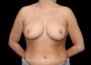 Breast Lift - Case 301 - After