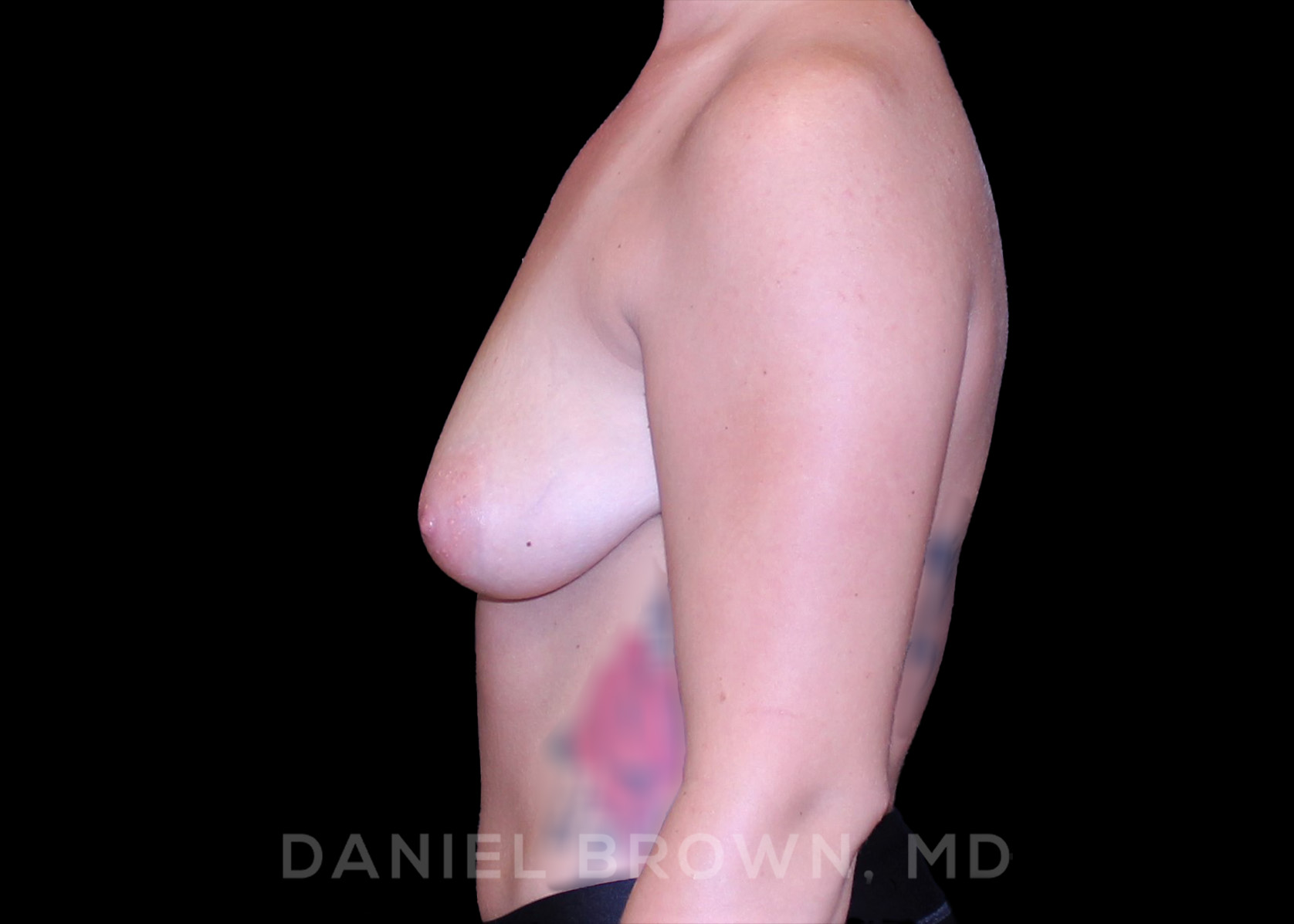 Breast Lift Patient Photo - Case 312 - before view-