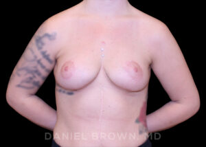 Breast Lift - Case 312 - After