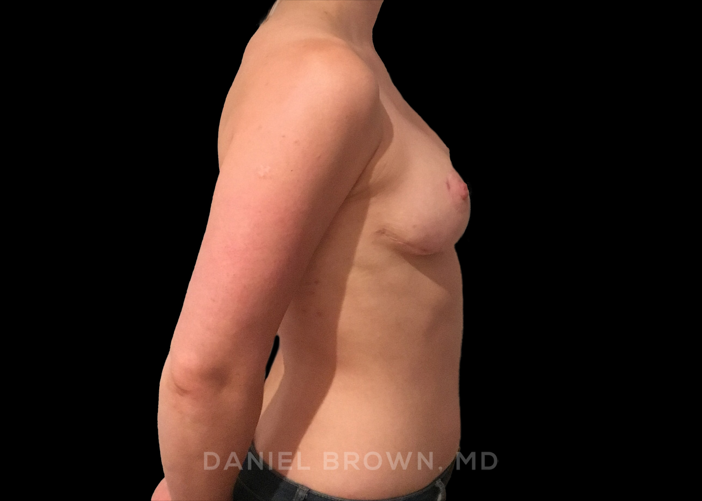 Breast Lift Patient Photo - Case 323 - after view