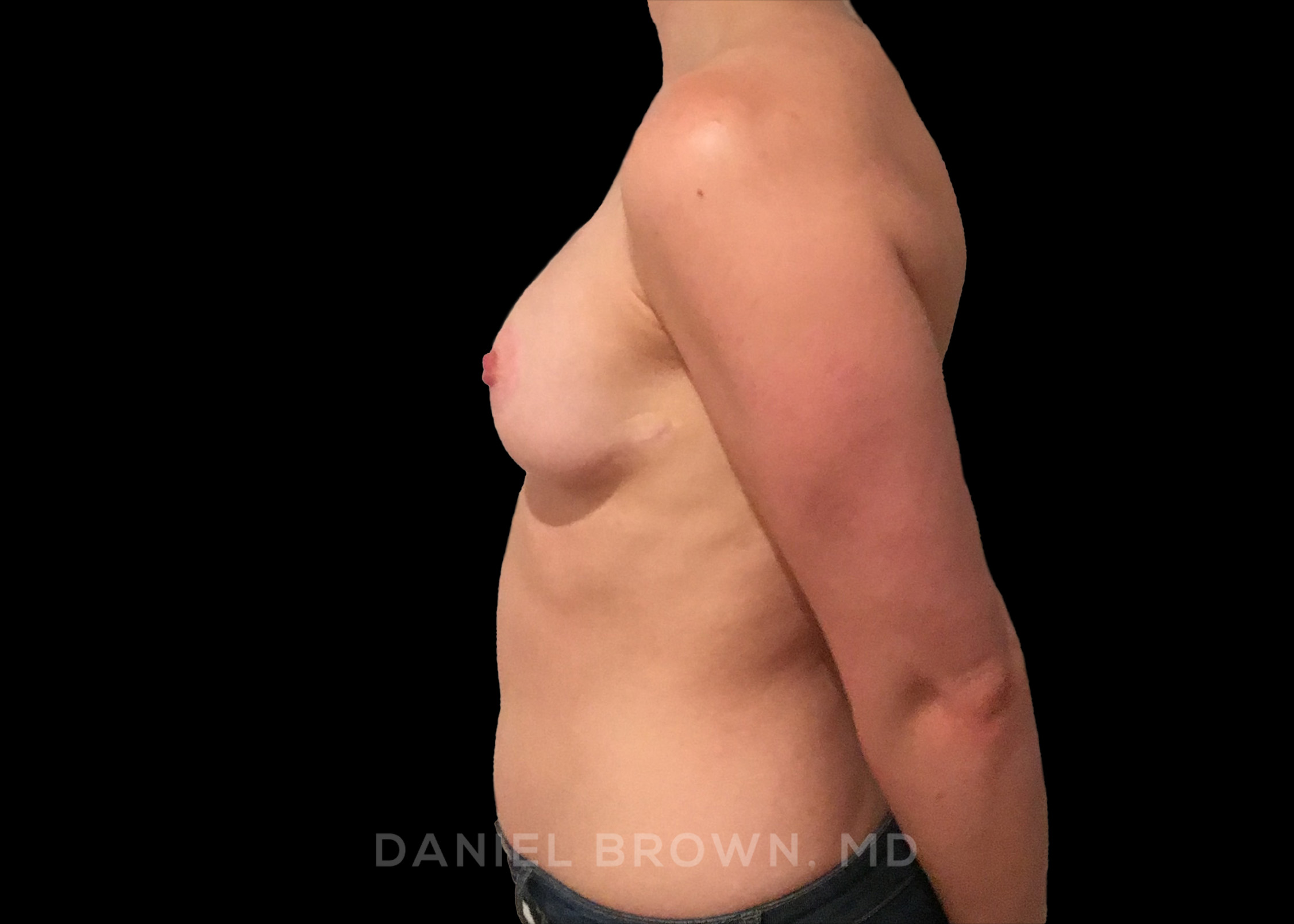 Breast Lift Patient Photo - Case 323 - after view-3
