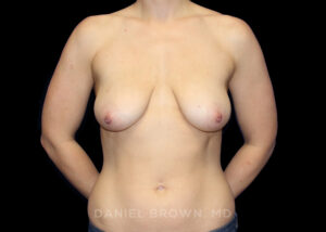 Breast Lift - Case 323 - Before