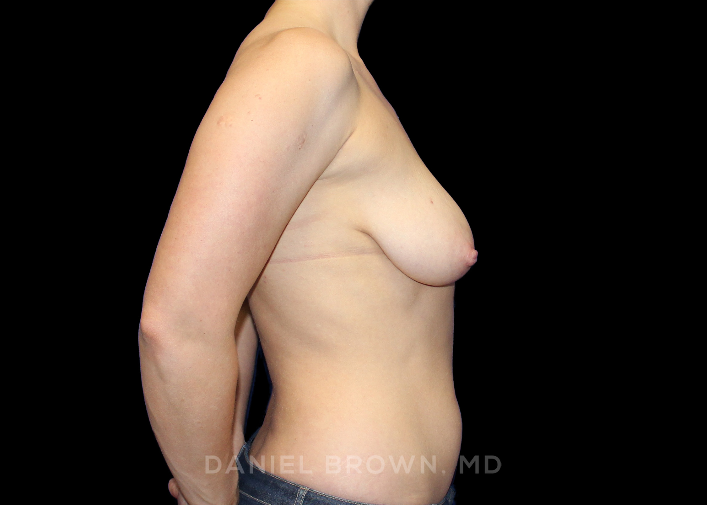 Breast Lift Patient Photo - Case 323 - before view-