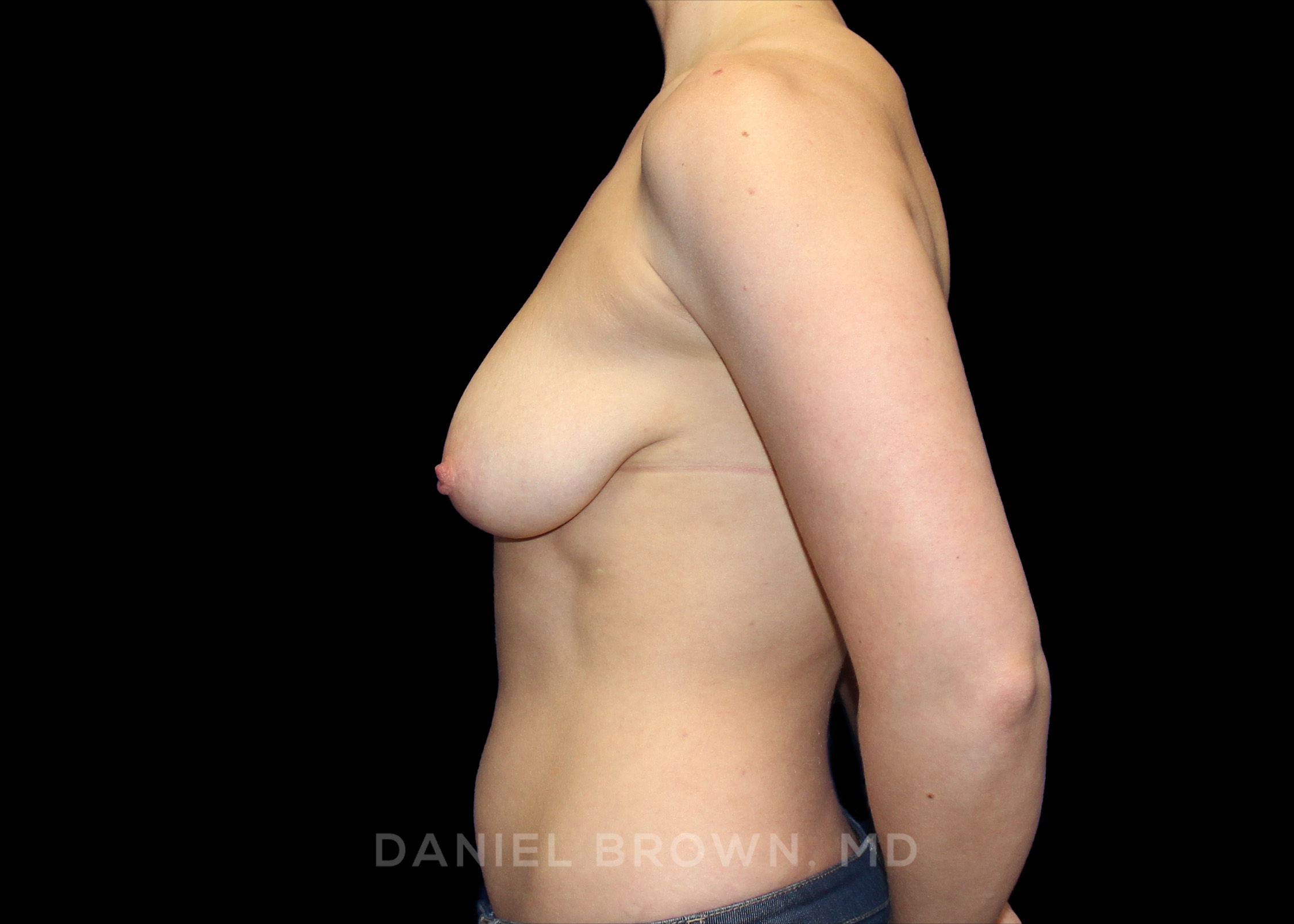 Breast Lift Patient Photo - Case 323 - before view-3