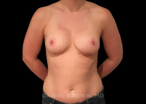 Breast Lift - Case 323 - After