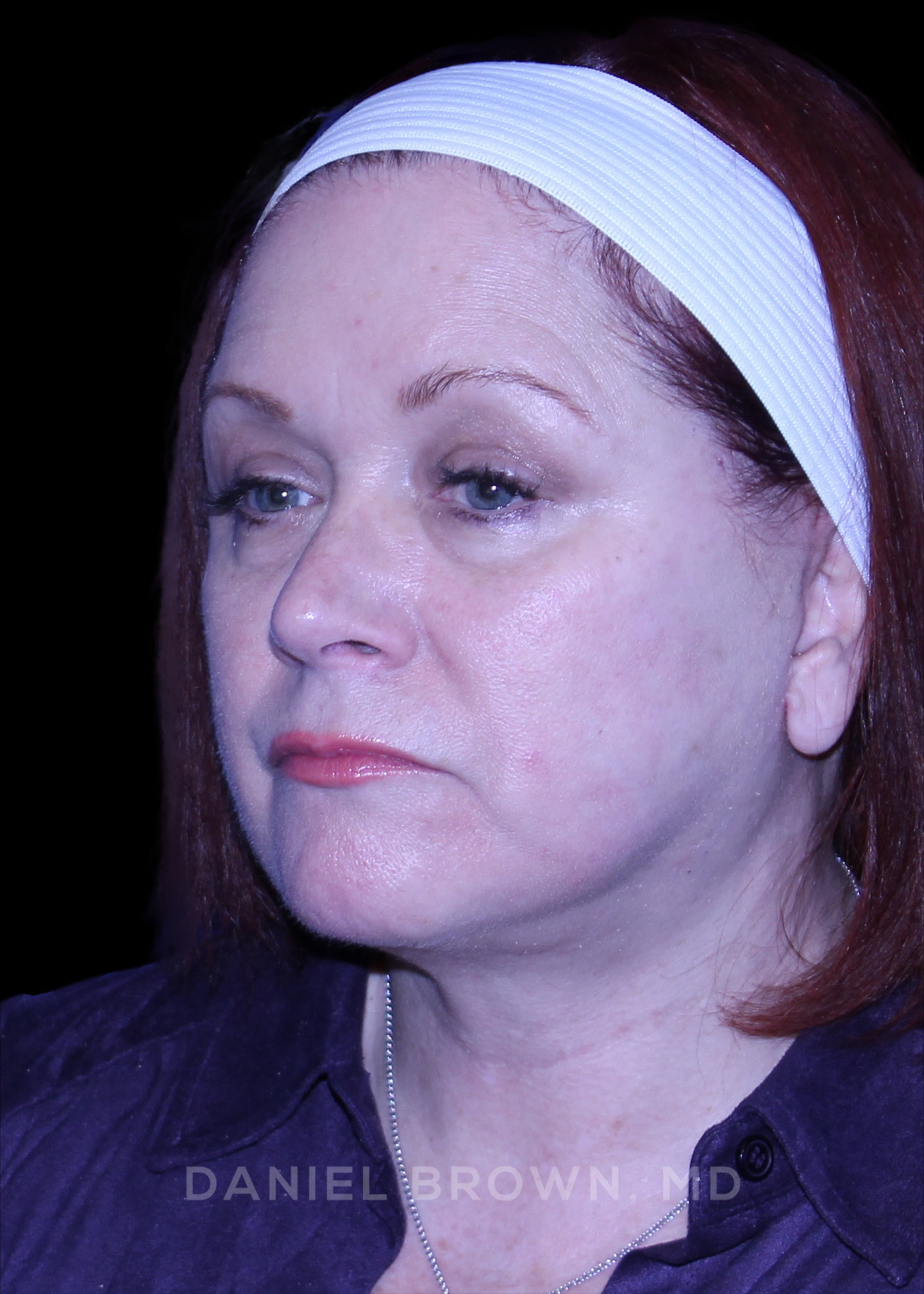 Blepharoplasty Patient Photo - Case 1000 - after view-3