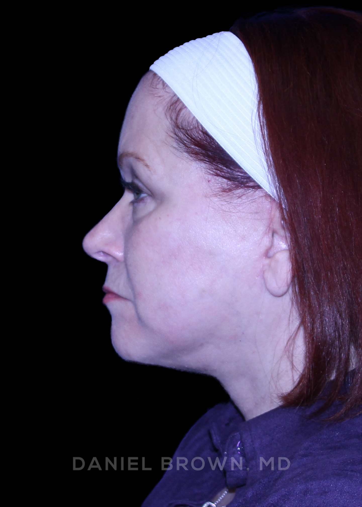 Blepharoplasty Patient Photo - Case 1000 - after view-4