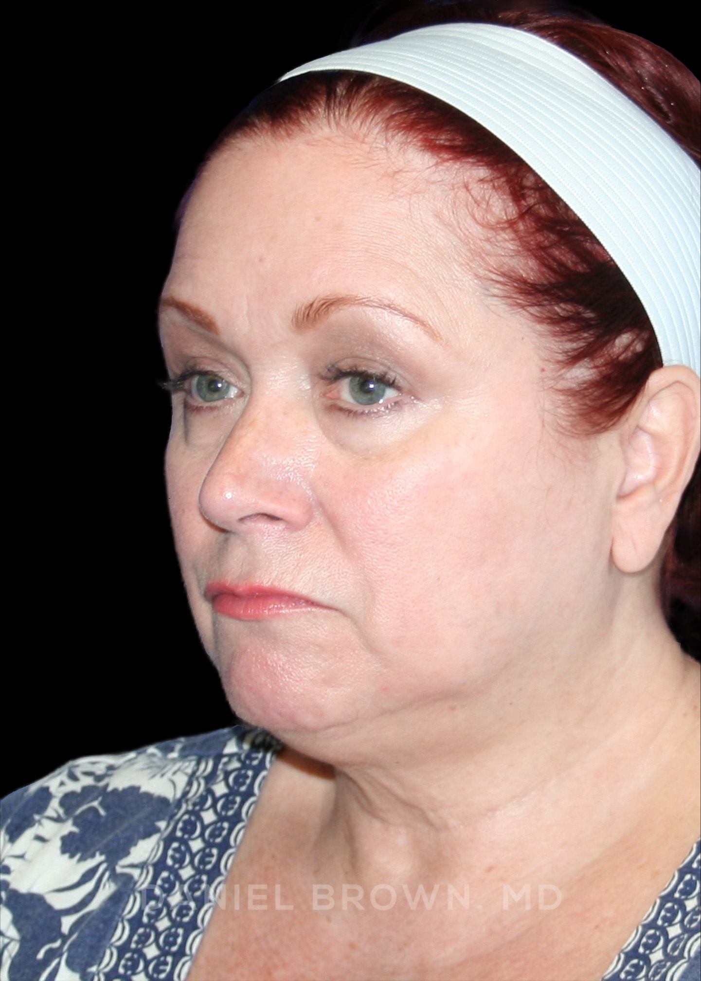 Blepharoplasty Patient Photo - Case 1000 - before view-