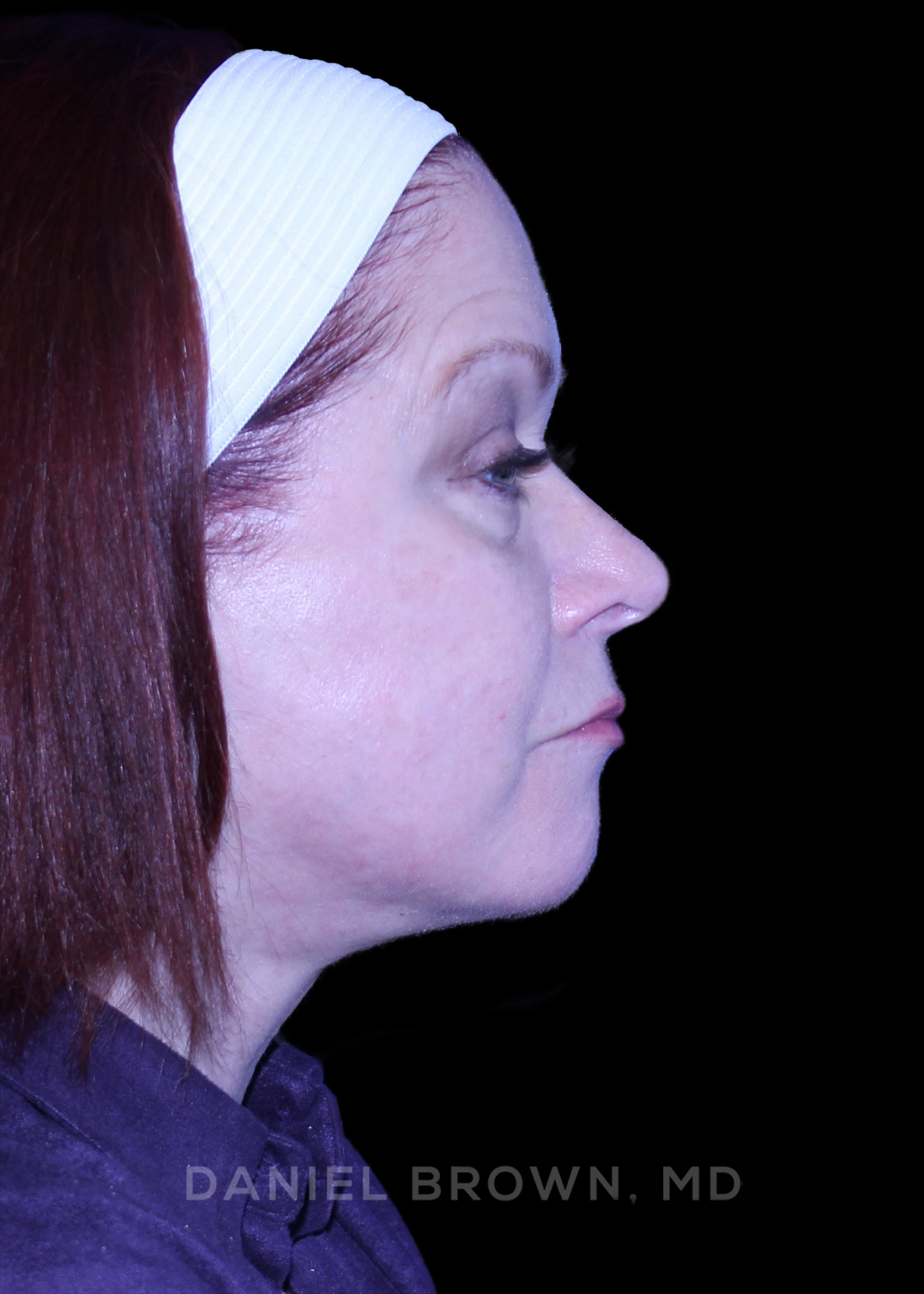 Blepharoplasty Patient Photo - Case 1000 - after view-6