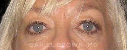Blepharoplasty Patient Photo - Case 1021 - after view