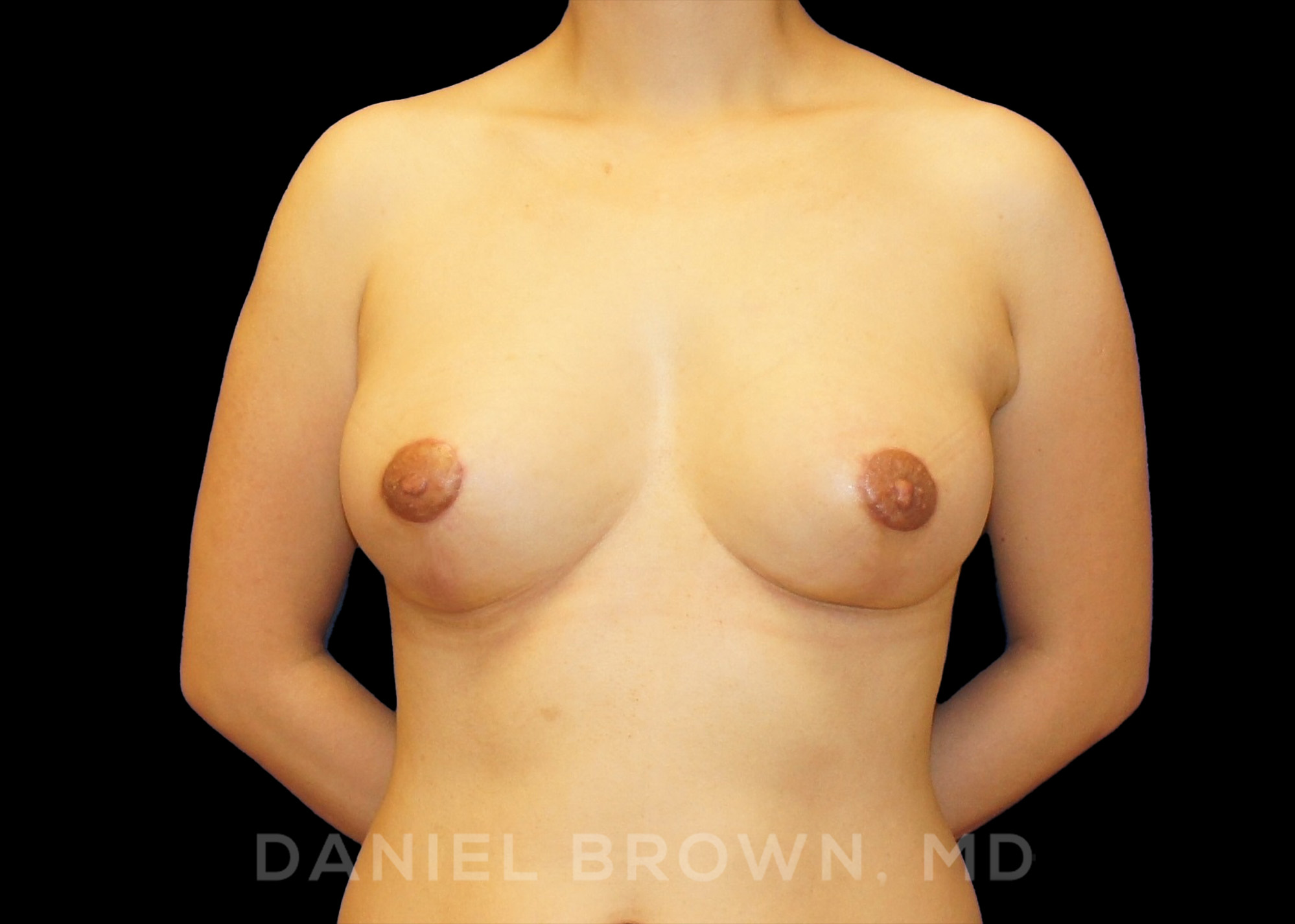 Breast Lift Patient Photo - Case 1026 - after view