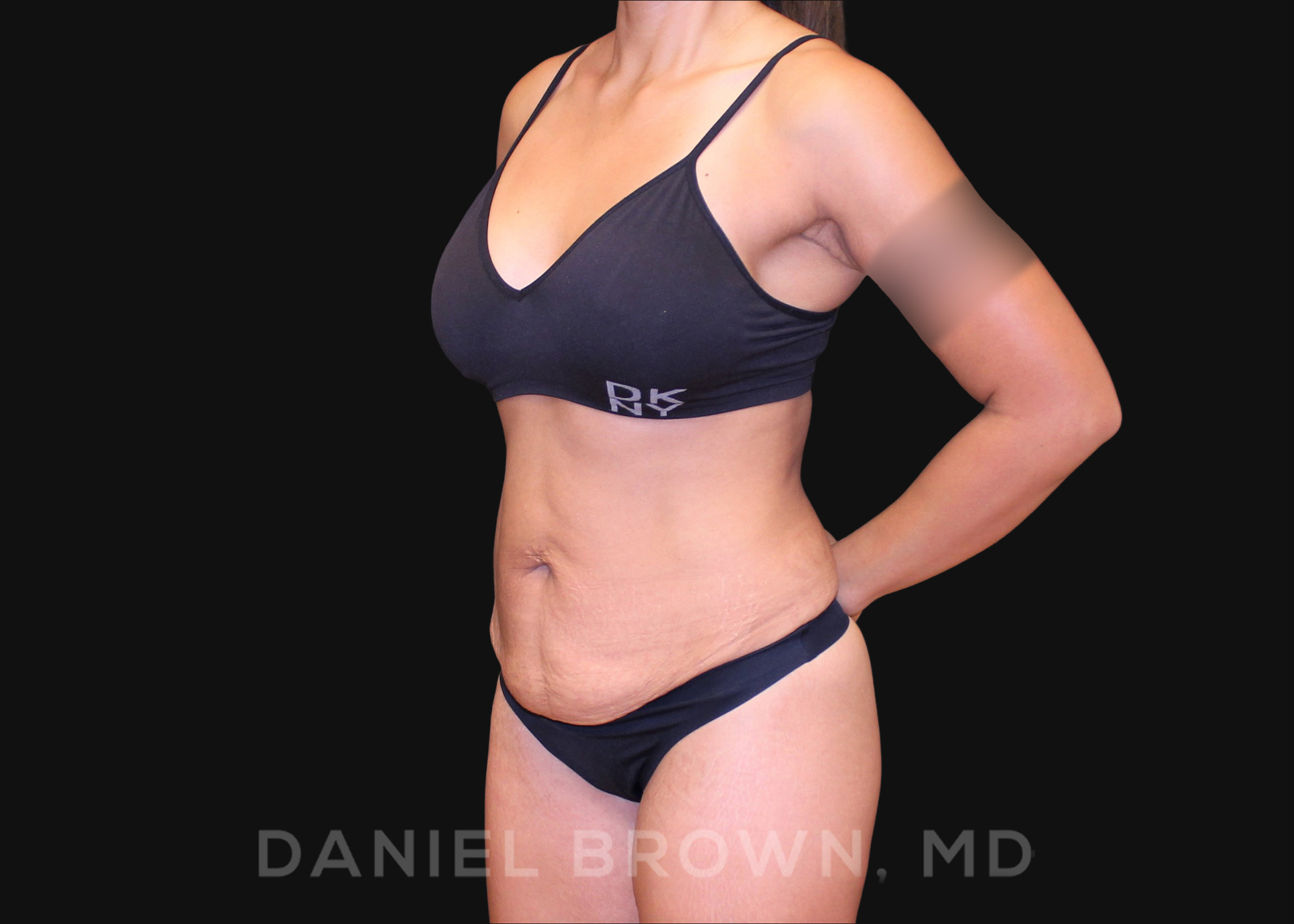 Tummy Tuck Patient Photo - Case 1040 - before view-1