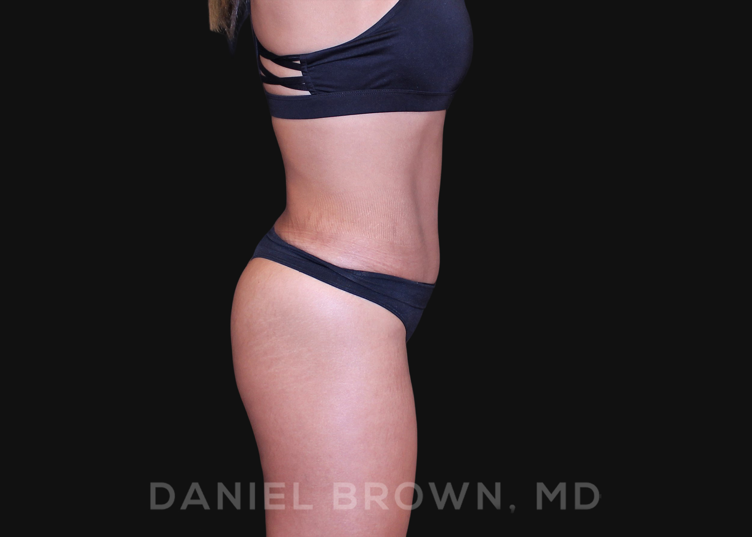 Tummy Tuck Patient Photo - Case 1040 - after view