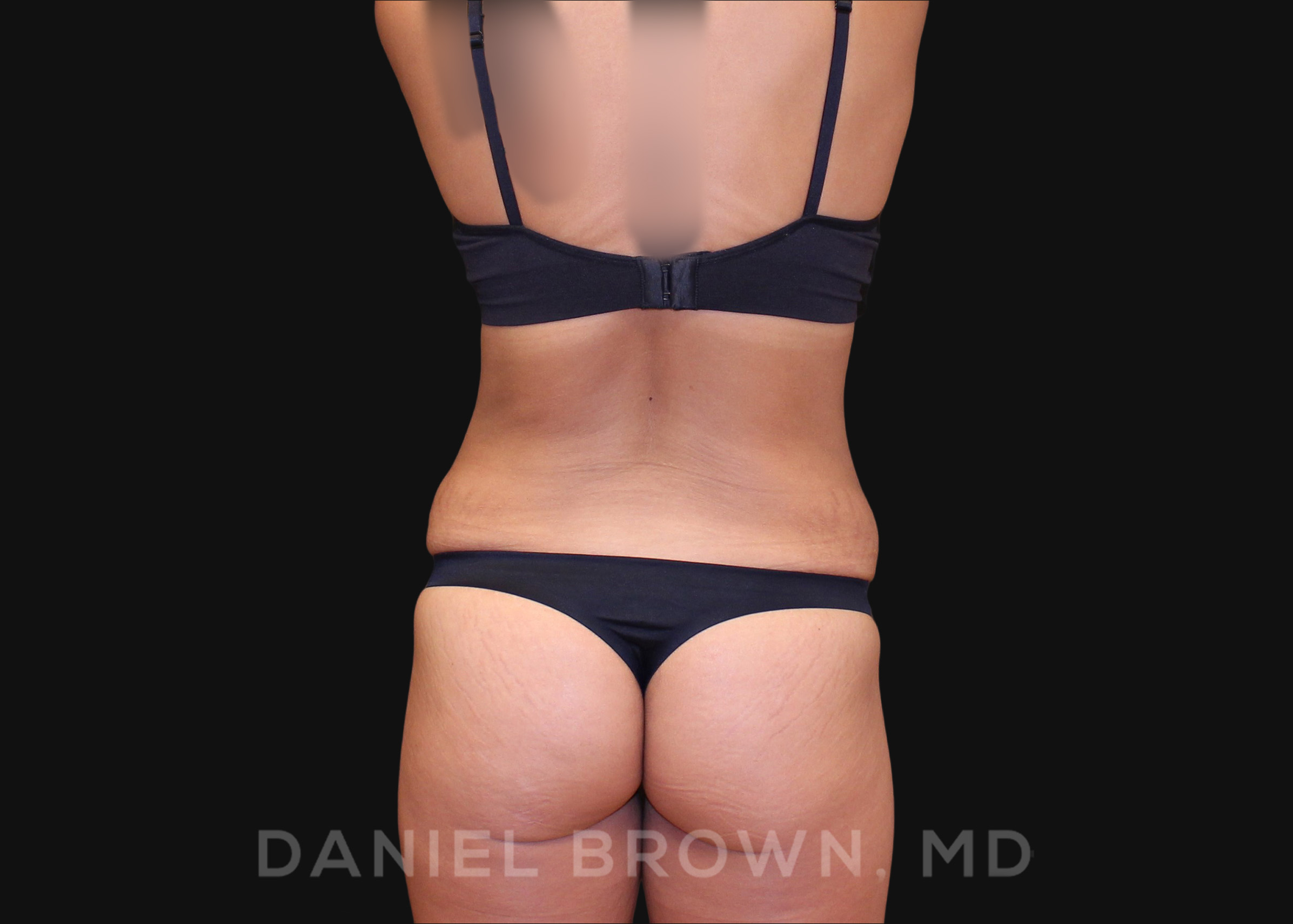 Tummy Tuck Patient Photo - Case 1040 - before view-5