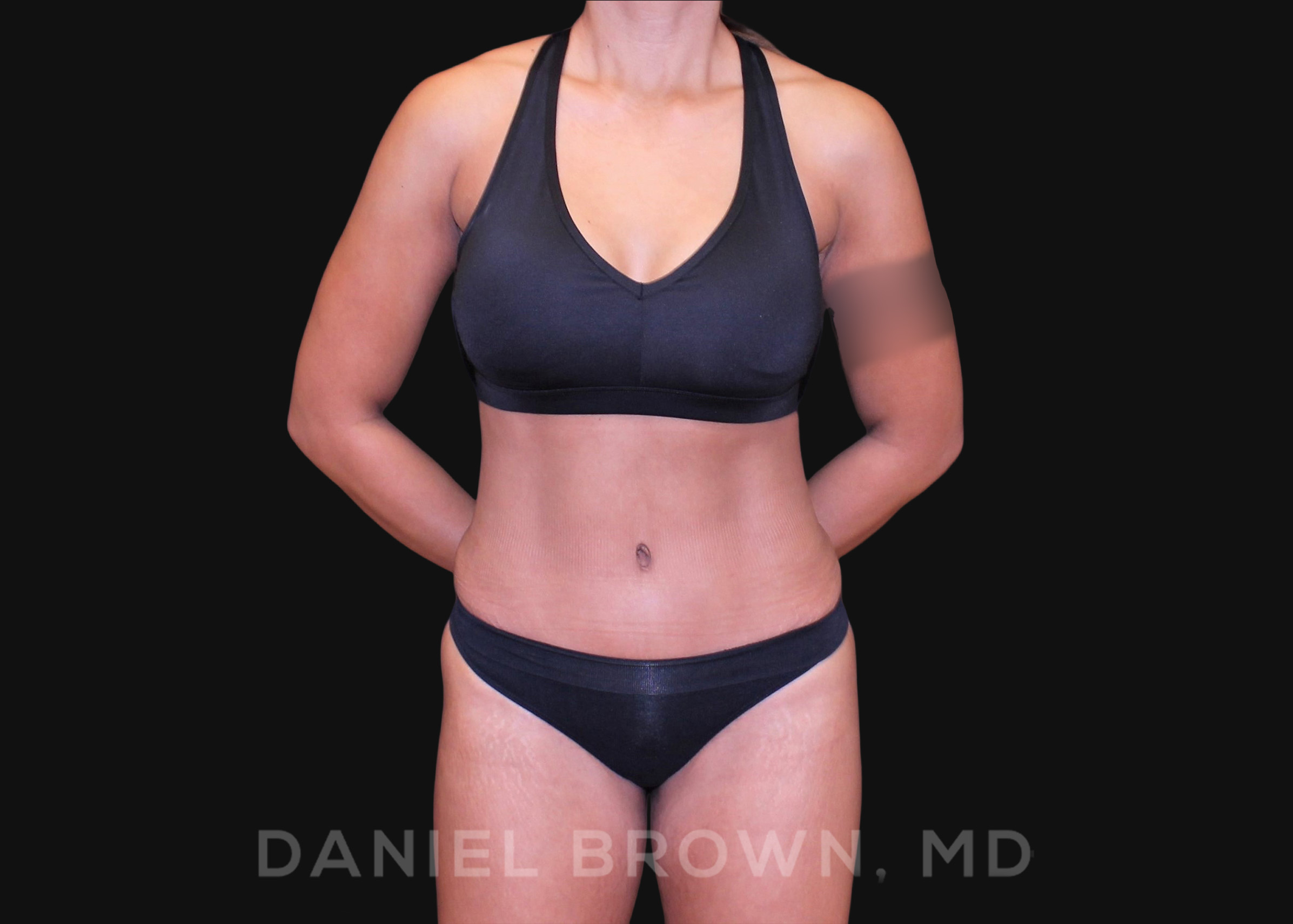 Tummy Tuck Patient Photo - Case 1040 - after view