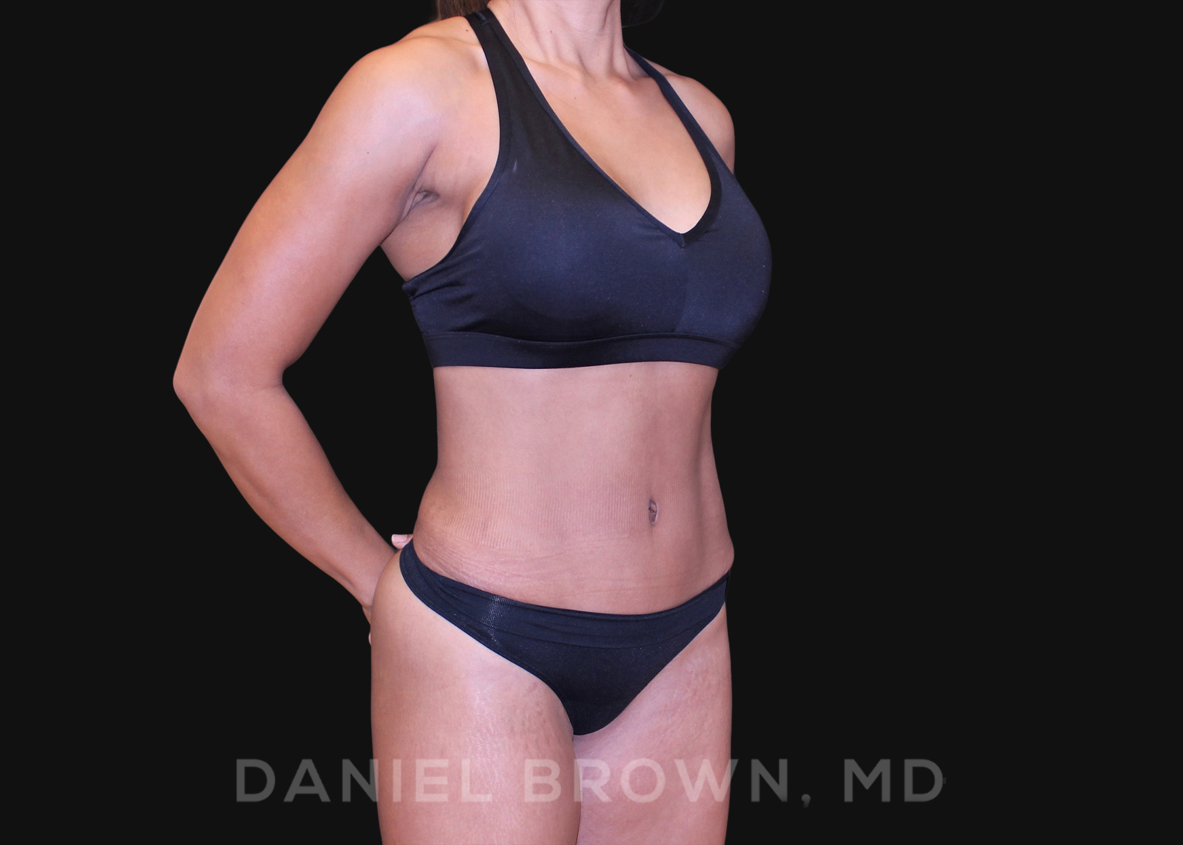 Tummy Tuck Patient Photo - Case 1040 - after view-2