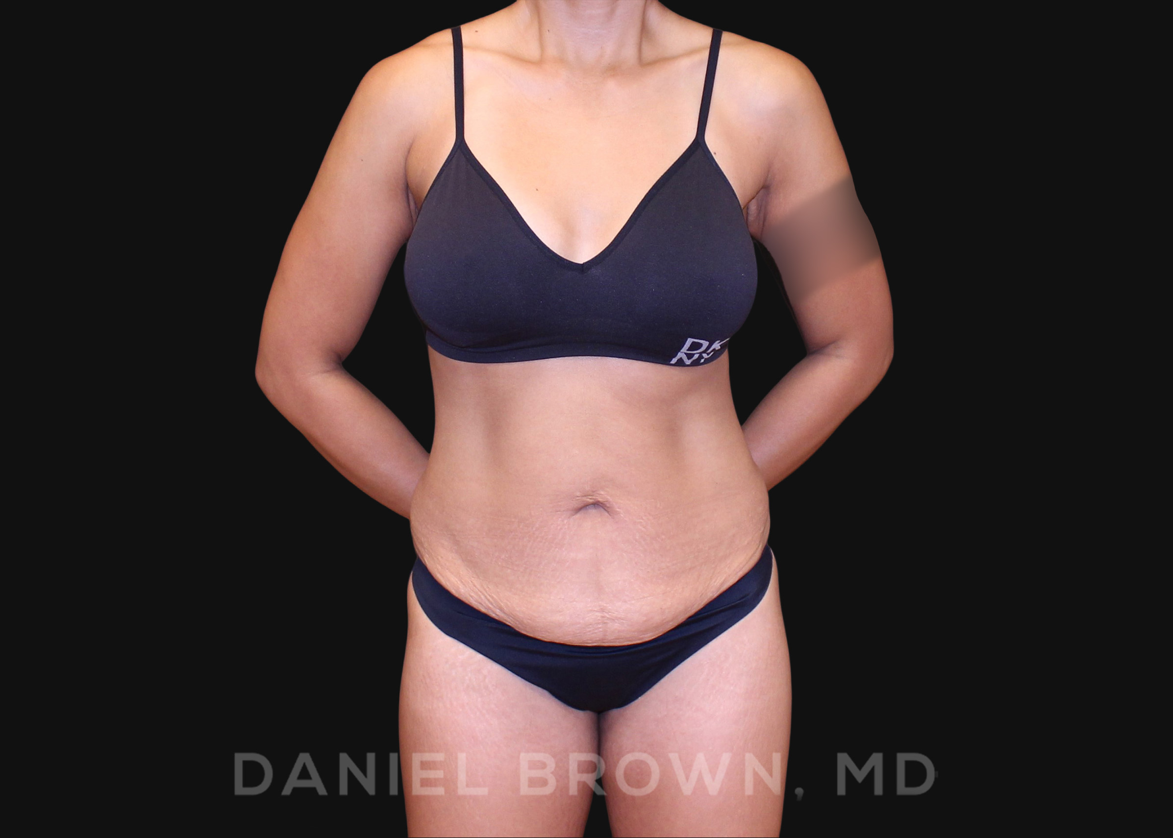Tummy Tuck Patient Photo - Case 1040 - before view-0