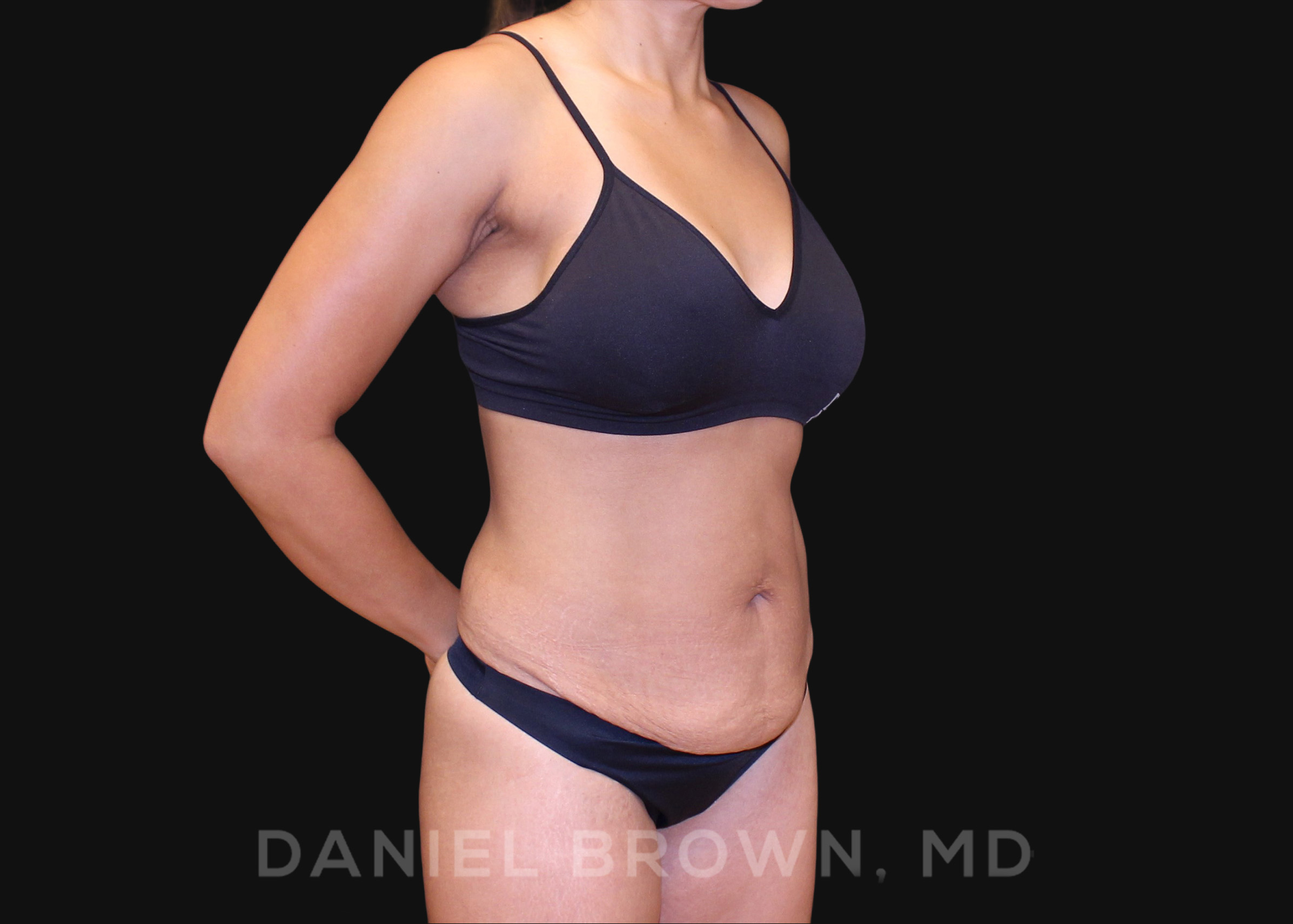 Tummy Tuck Patient Photo - Case 1040 - before view-2