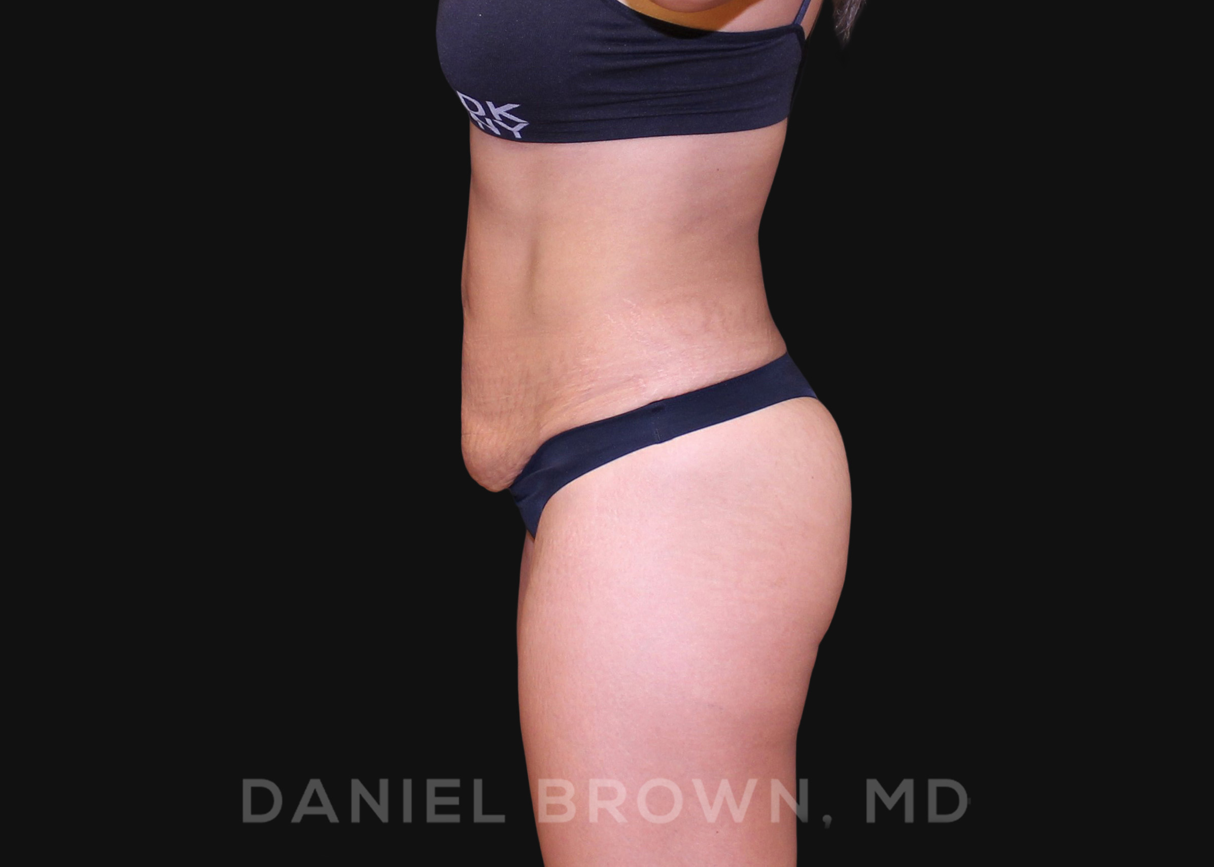 Tummy Tuck Patient Photo - Case 1040 - before view-3