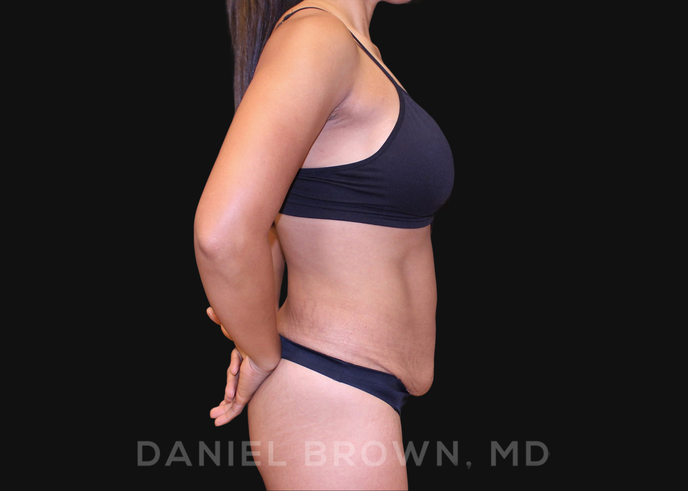 Tummy Tuck Patient Photo - Case 1040 - before view-4