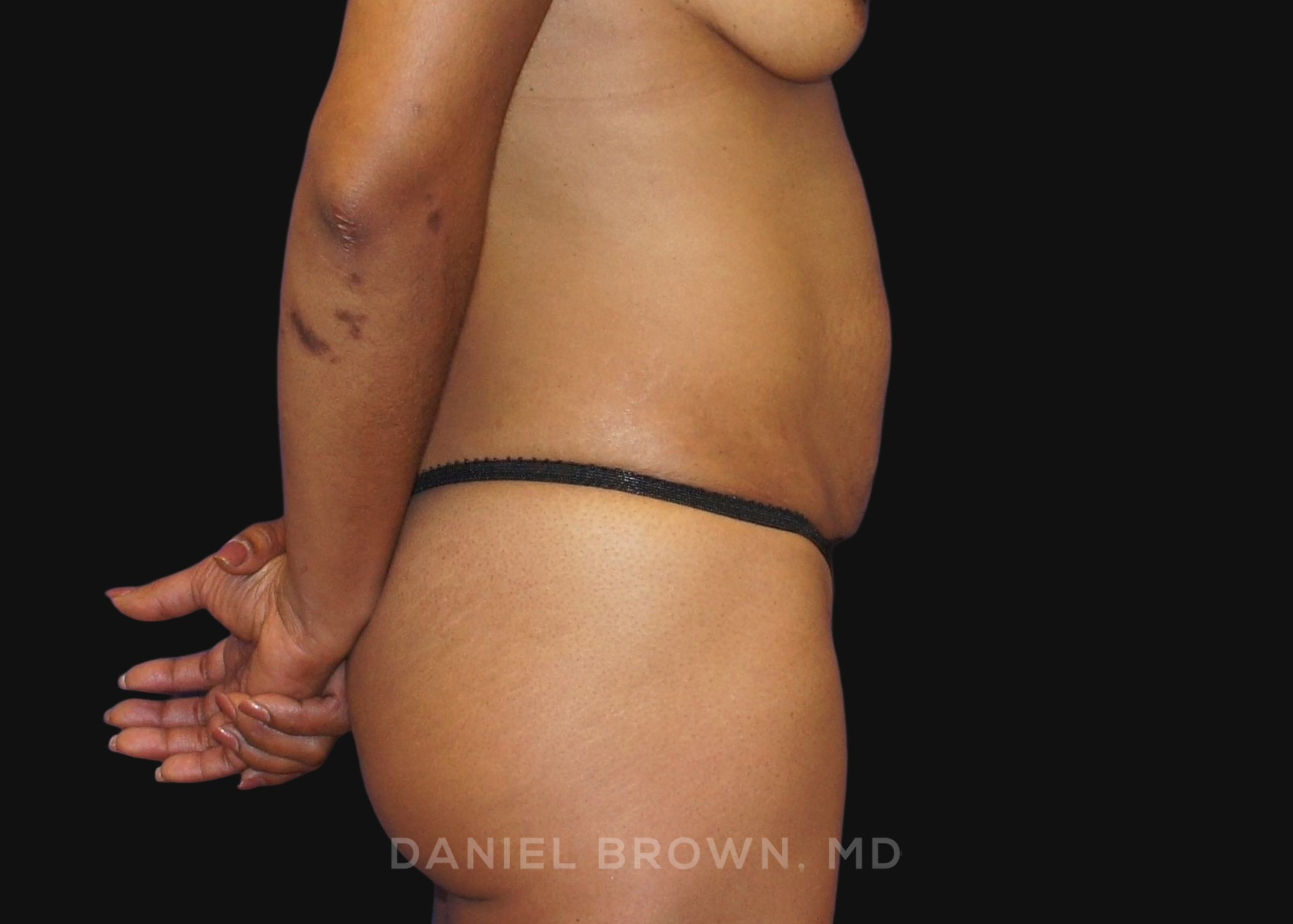 Tummy Tuck Patient Photo - Case 1053 - before view-4