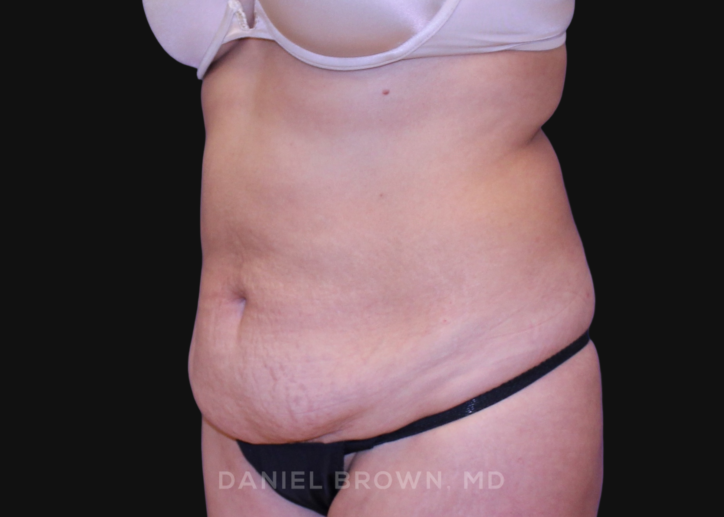 Tummy Tuck Patient Photo - Case 1064 - before view-1