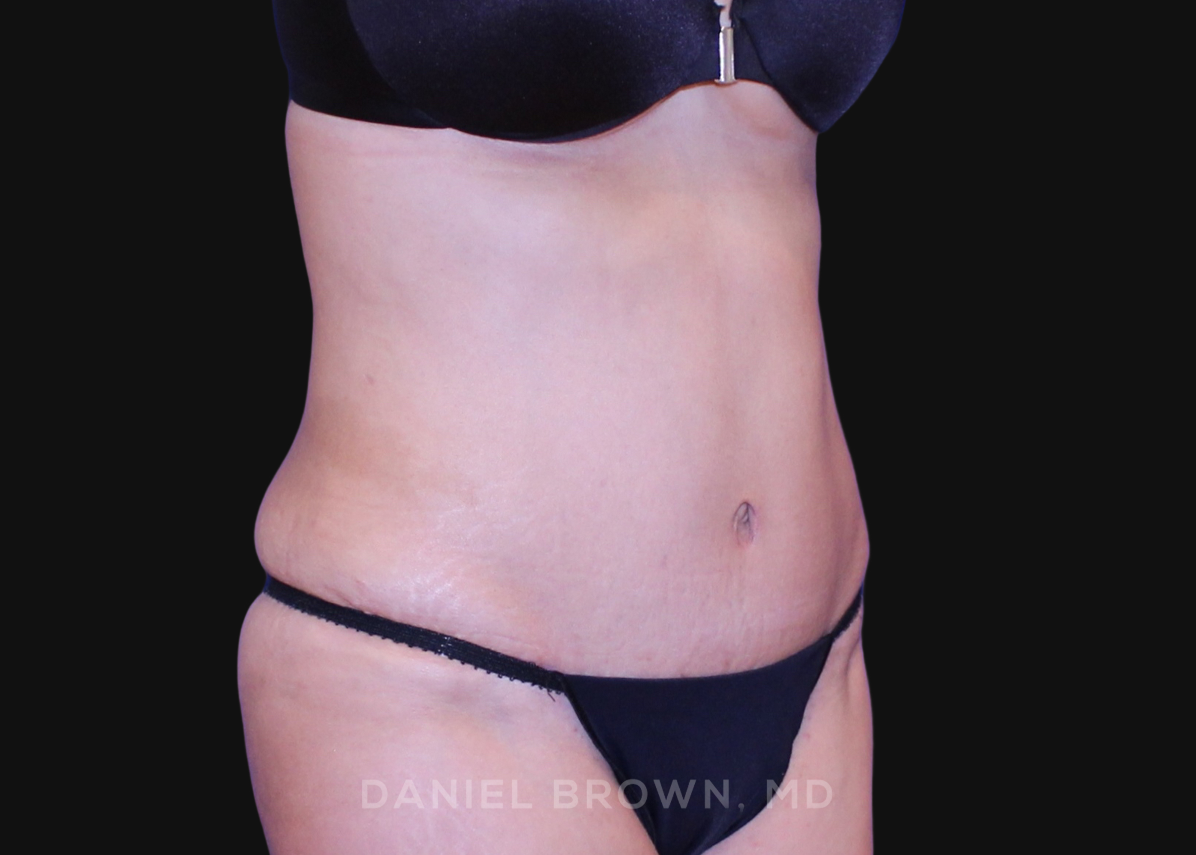 Tummy Tuck Patient Photo - Case 1064 - after view-2