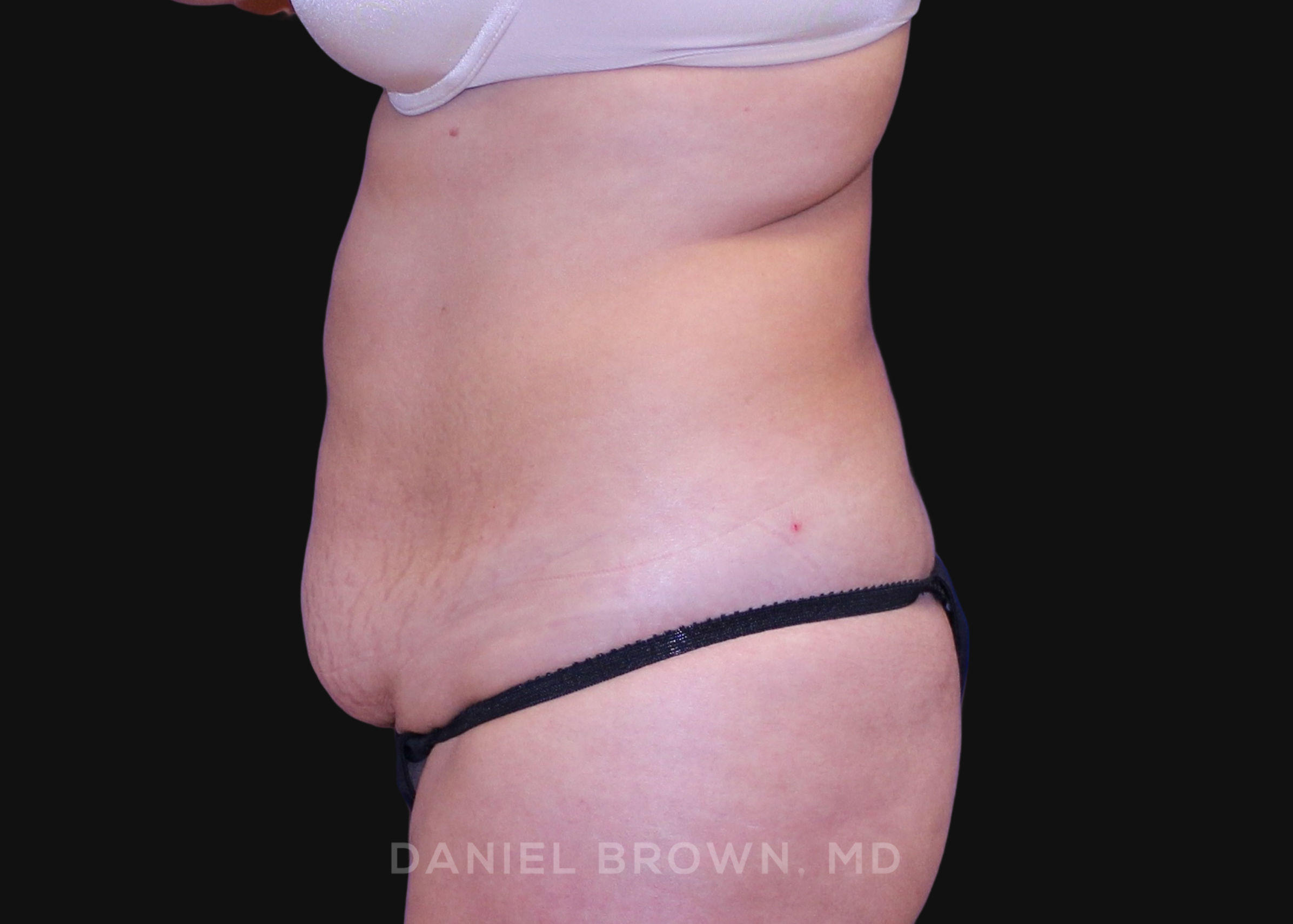 Tummy Tuck Patient Photo - Case 1064 - before view-3