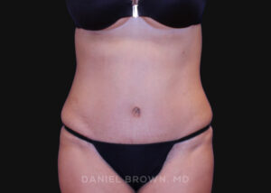 Tummy Tuck - Case 1064 - After