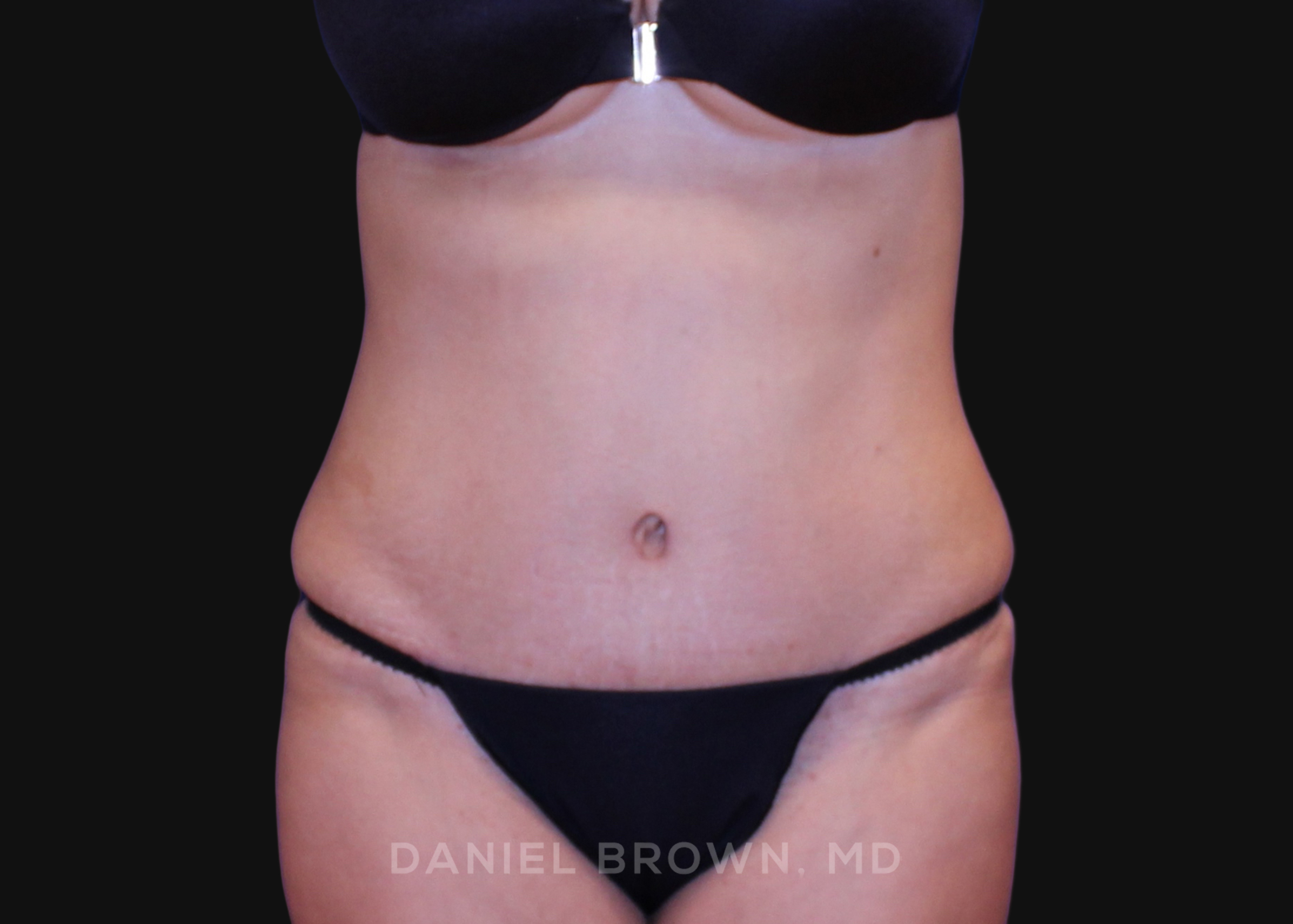 Tummy Tuck Patient Photo - Case 1064 - after view-0