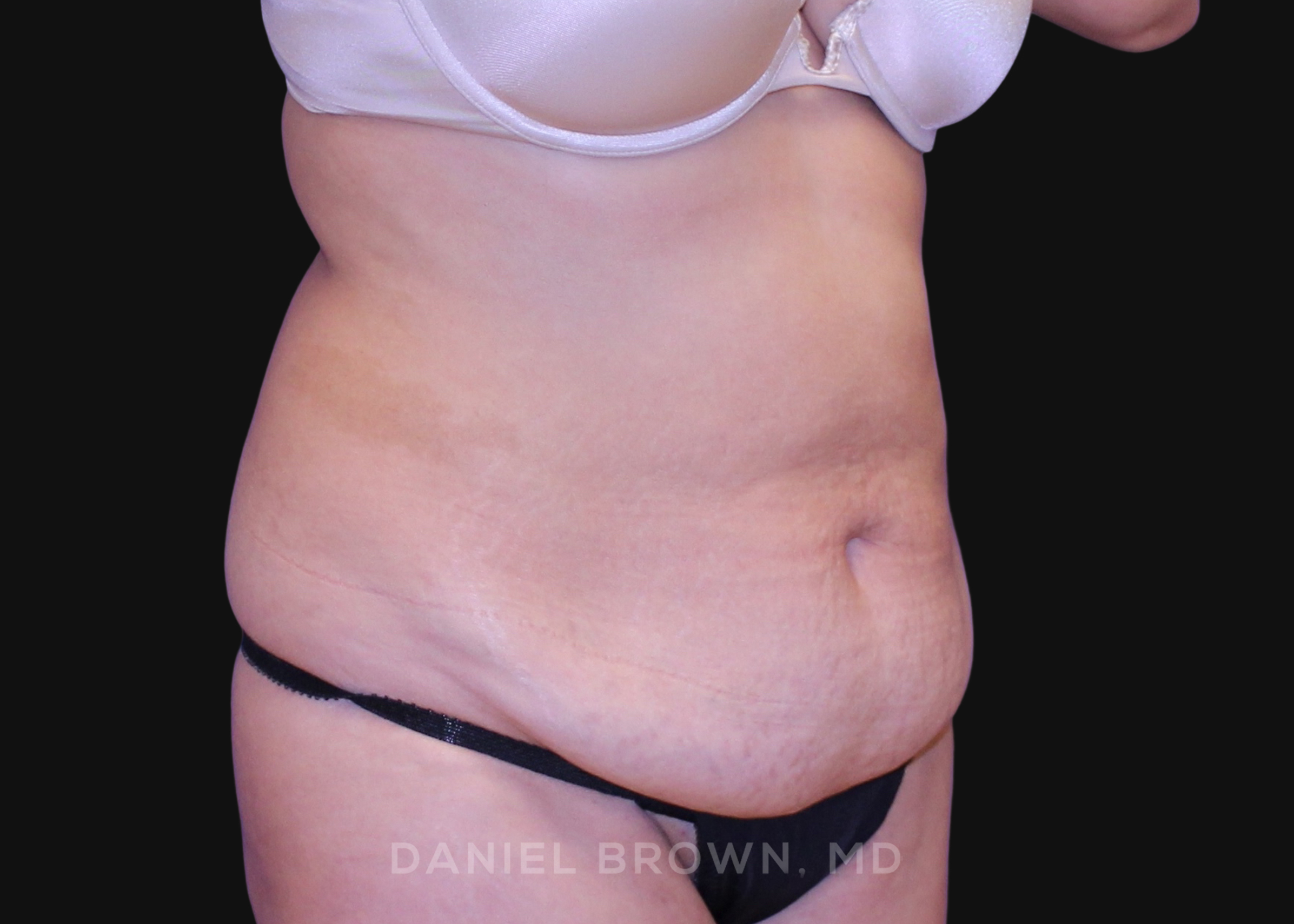 Tummy Tuck Patient Photo - Case 1064 - before view-2