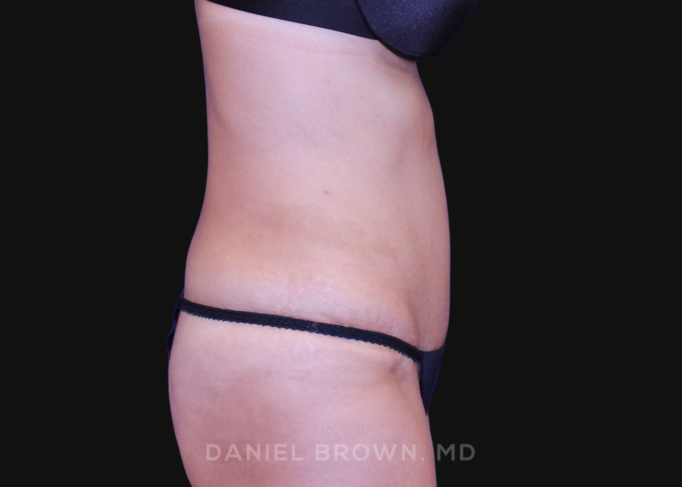 Tummy Tuck Patient Photo - Case 1064 - after view-4