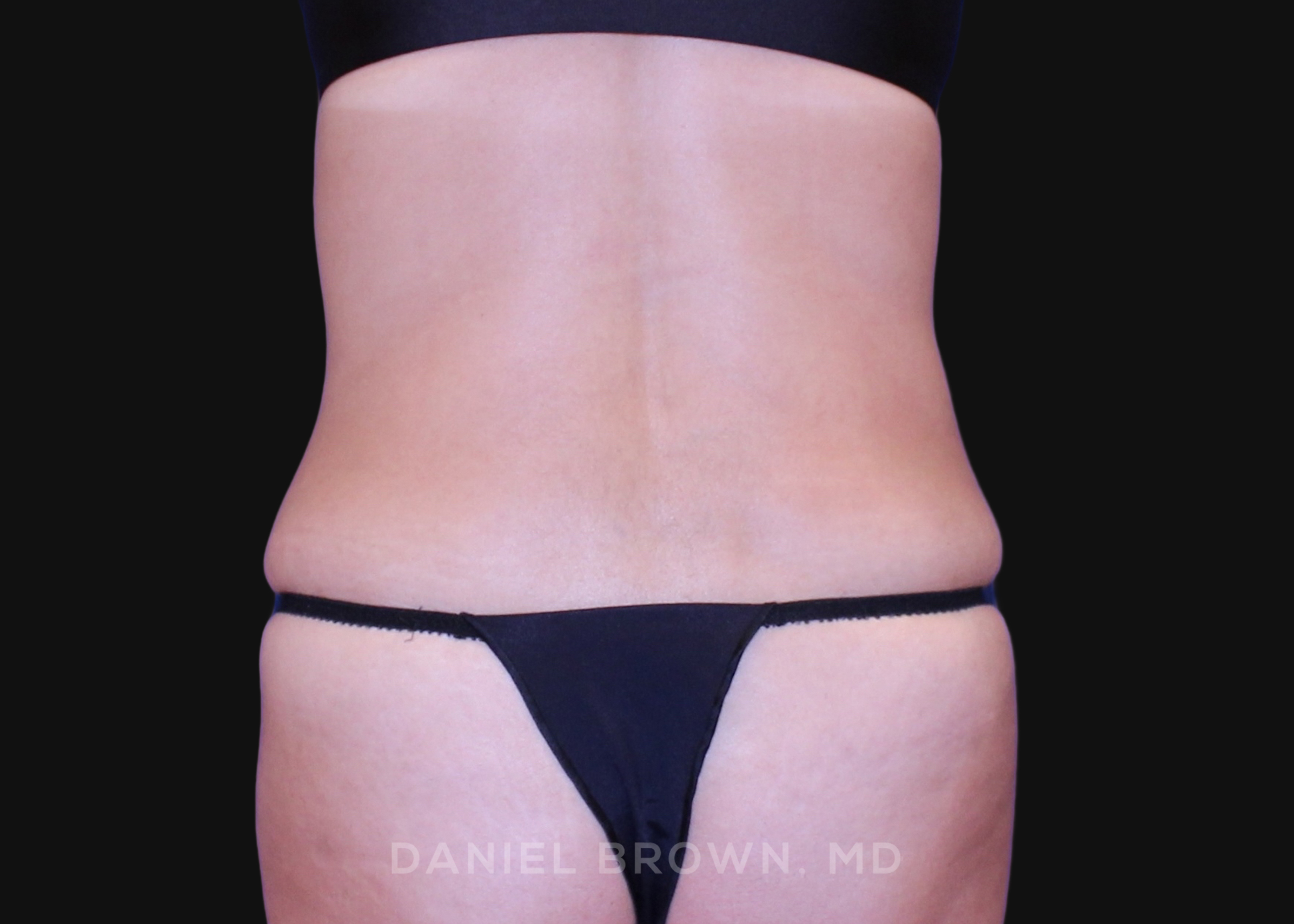Tummy Tuck Patient Photo - Case 1064 - after view-5