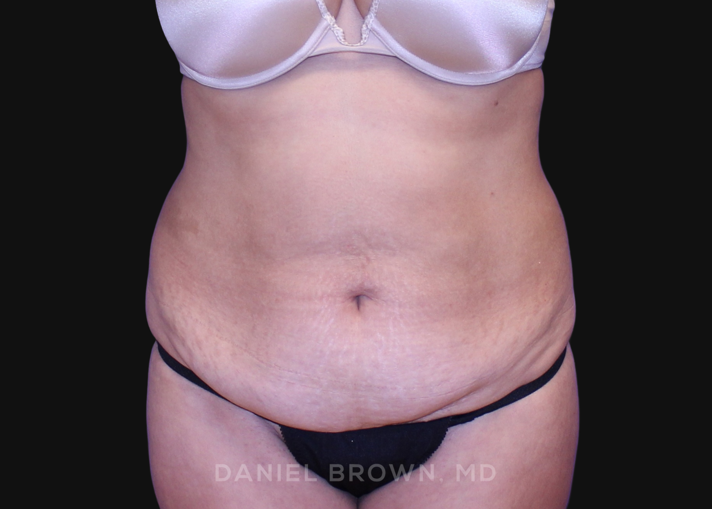 Tummy Tuck Patient Photo - Case 1064 - before view-