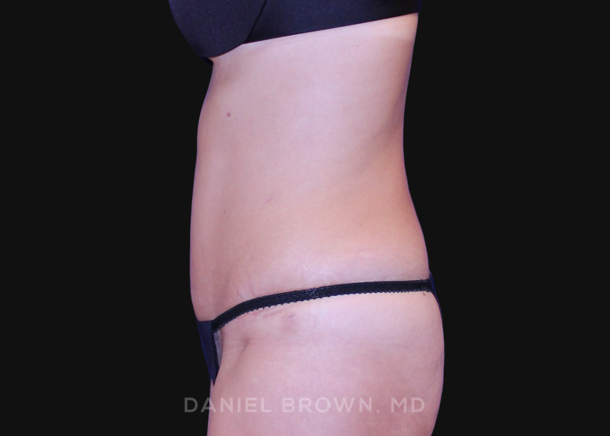 Tummy Tuck Patient Photo - Case 1064 - after view