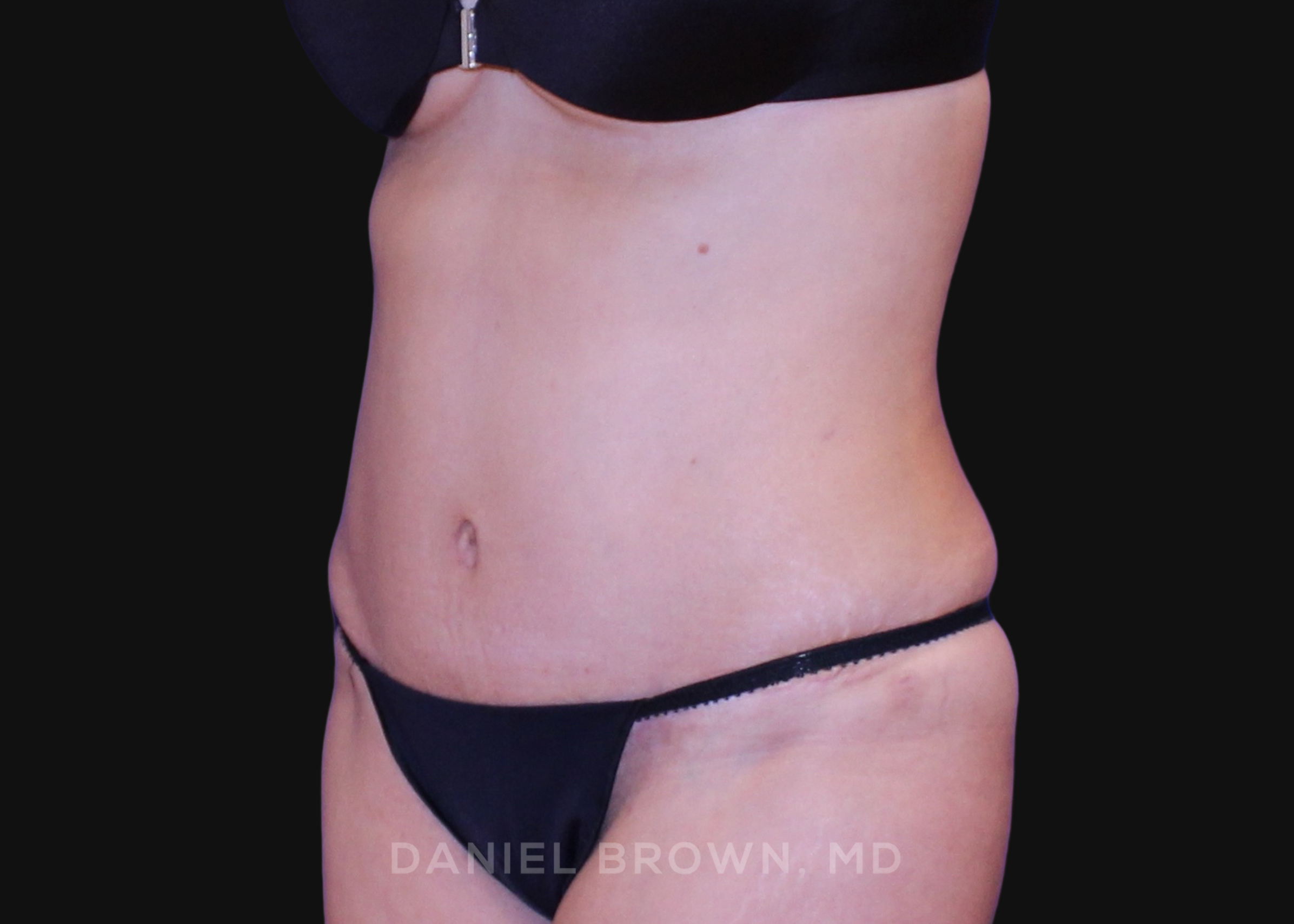 Tummy Tuck Patient Photo - Case 1064 - after view-1