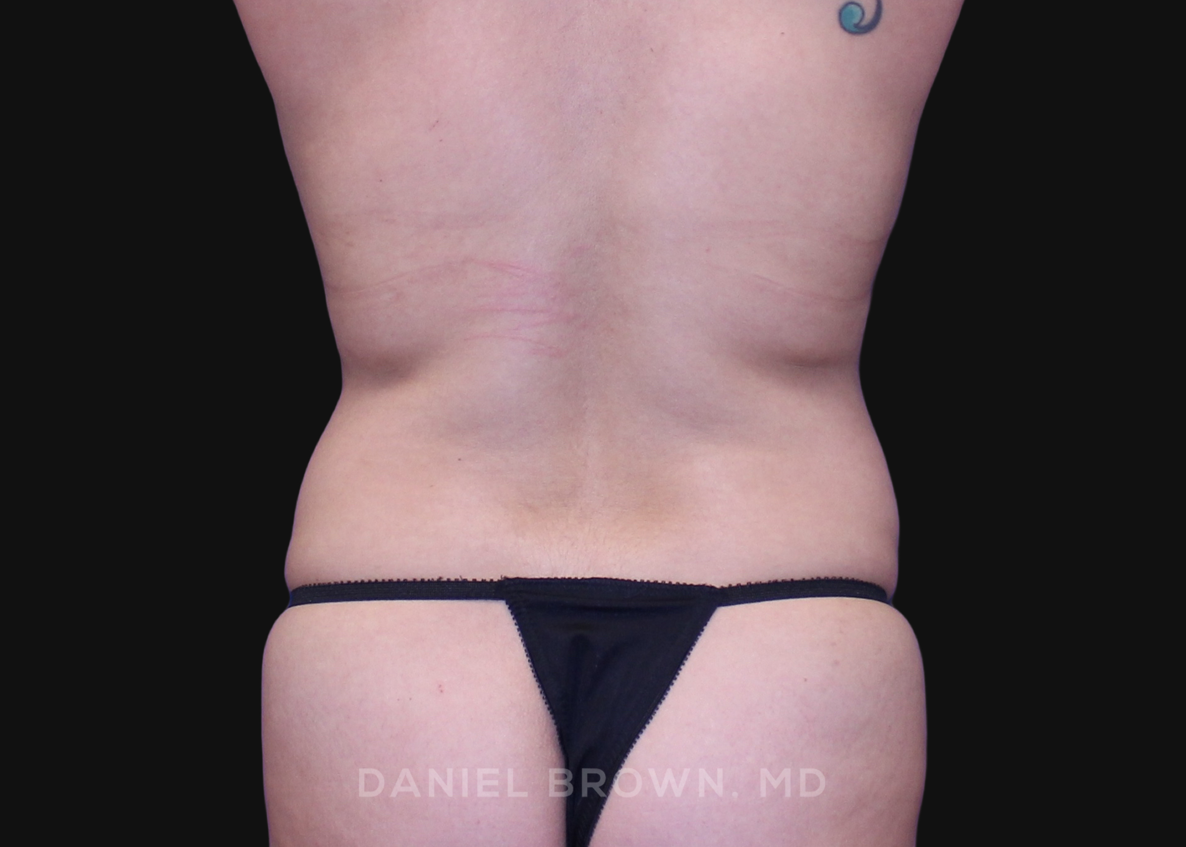 Tummy Tuck Patient Photo - Case 1077 - before view-