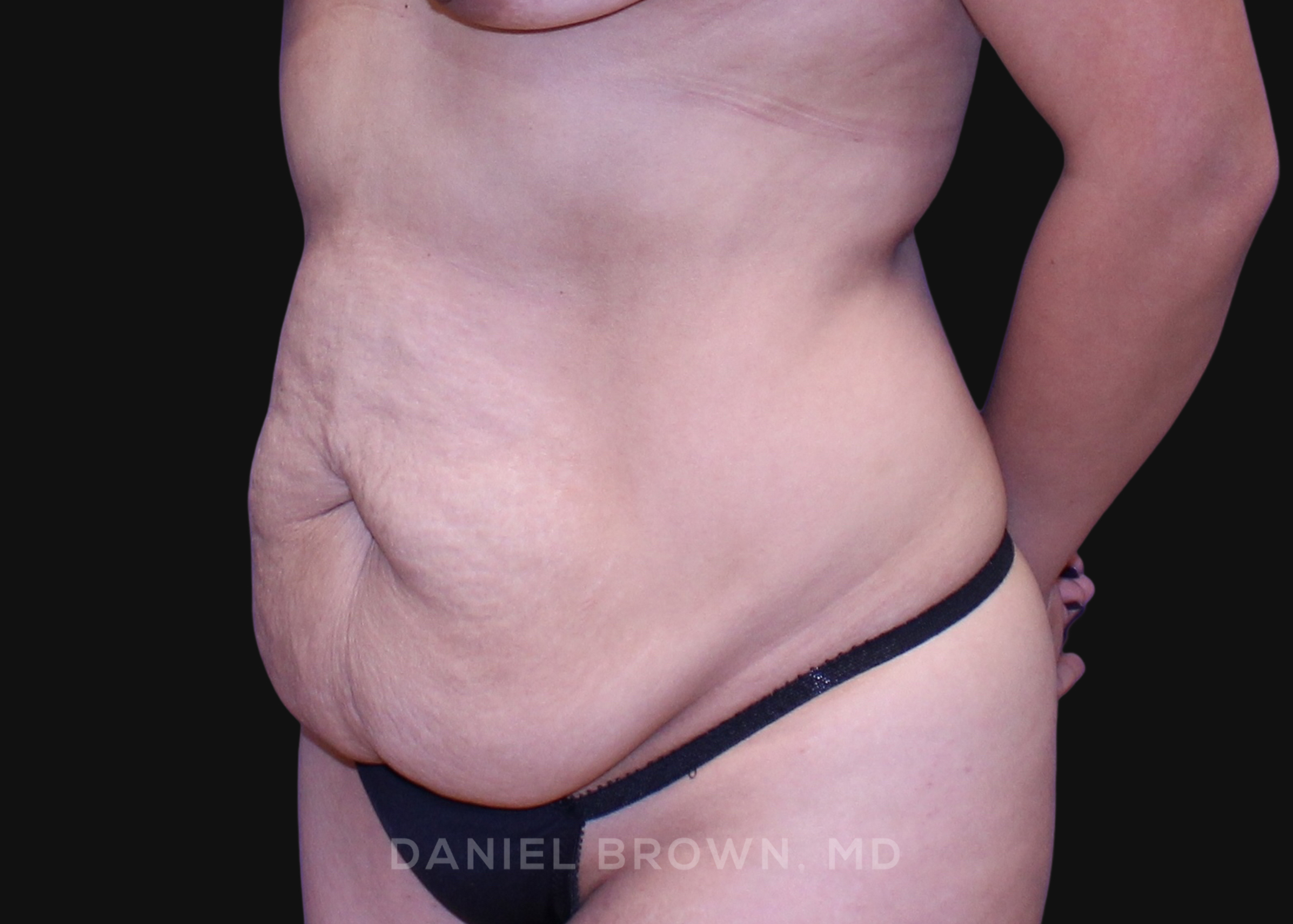 Tummy Tuck Patient Photo - Case 1077 - before view-