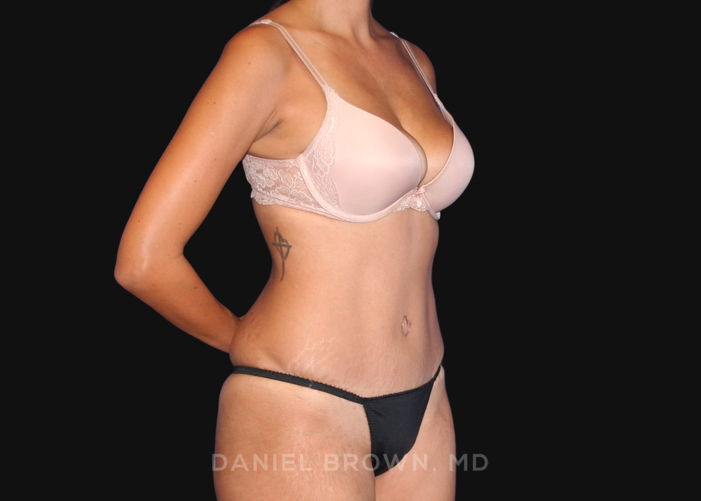 Tummy Tuck Patient Photo - Case 1090 - after view-2