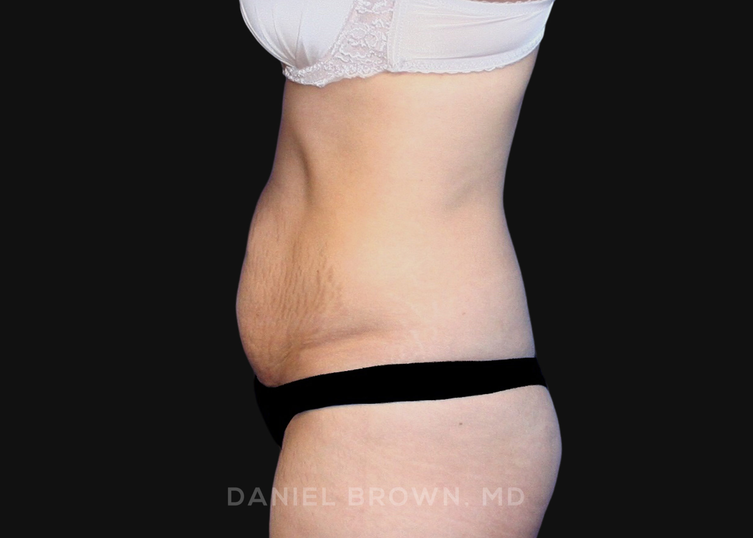 Tummy Tuck Patient Photo - Case 1090 - before view-3