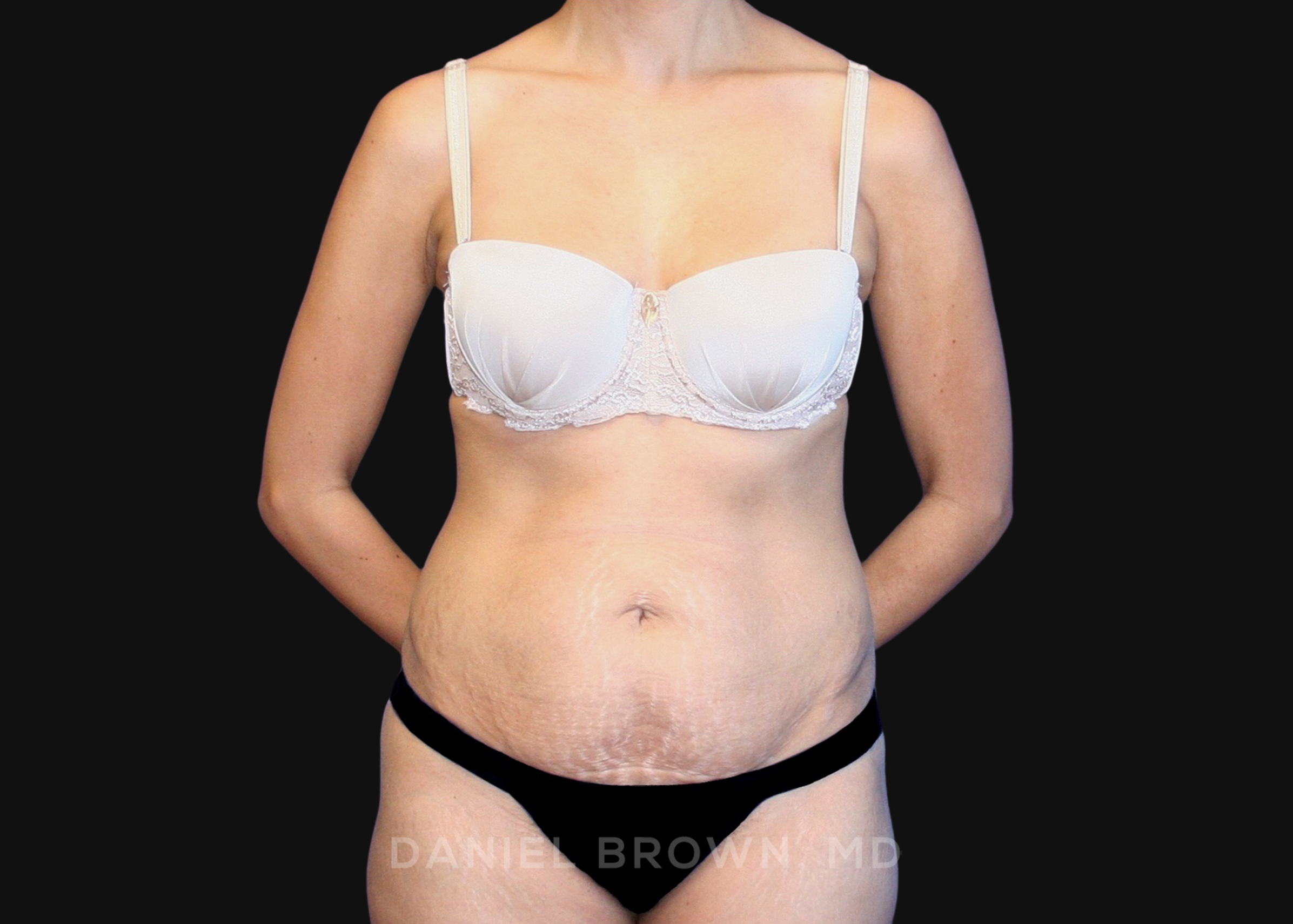 Tummy Tuck Patient Photo - Case 1090 - before view-0