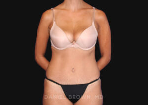 Tummy Tuck - Case 1090 - After