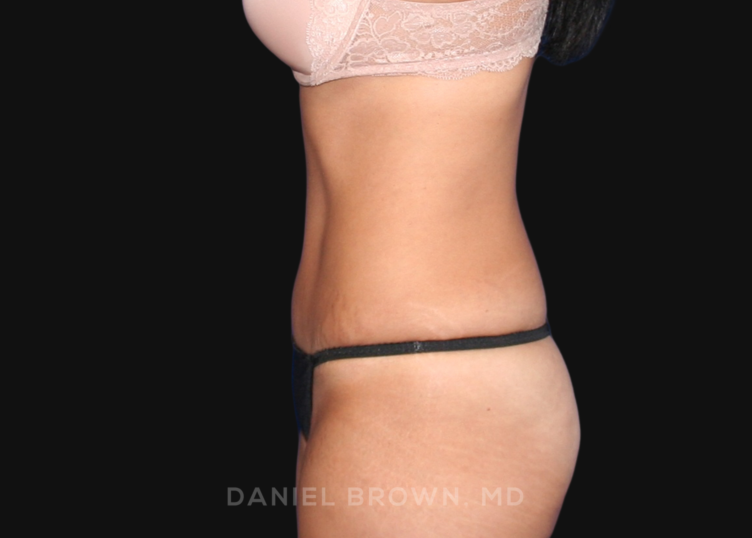 Tummy Tuck Patient Photo - Case 1090 - after view-3