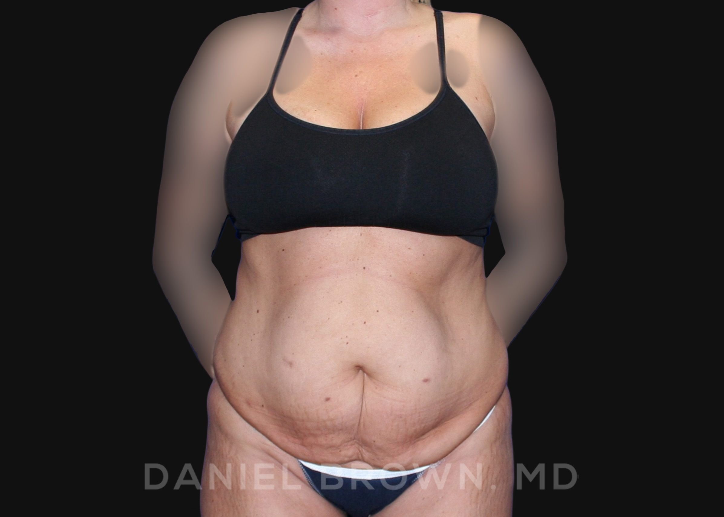 Tummy Tuck Patient Photo - Case 1101 - before view-