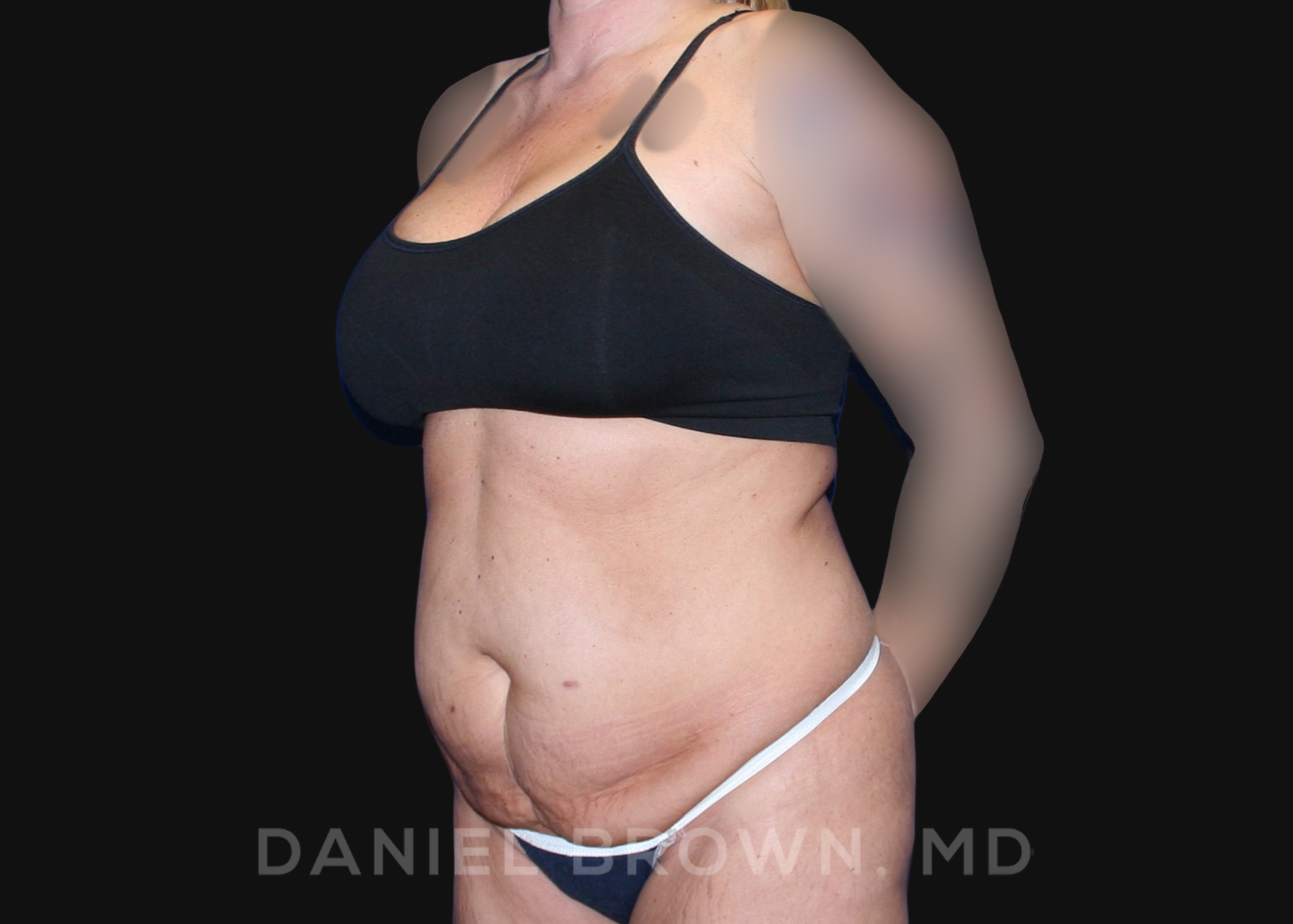 Tummy Tuck Patient Photo - Case 1101 - before view-