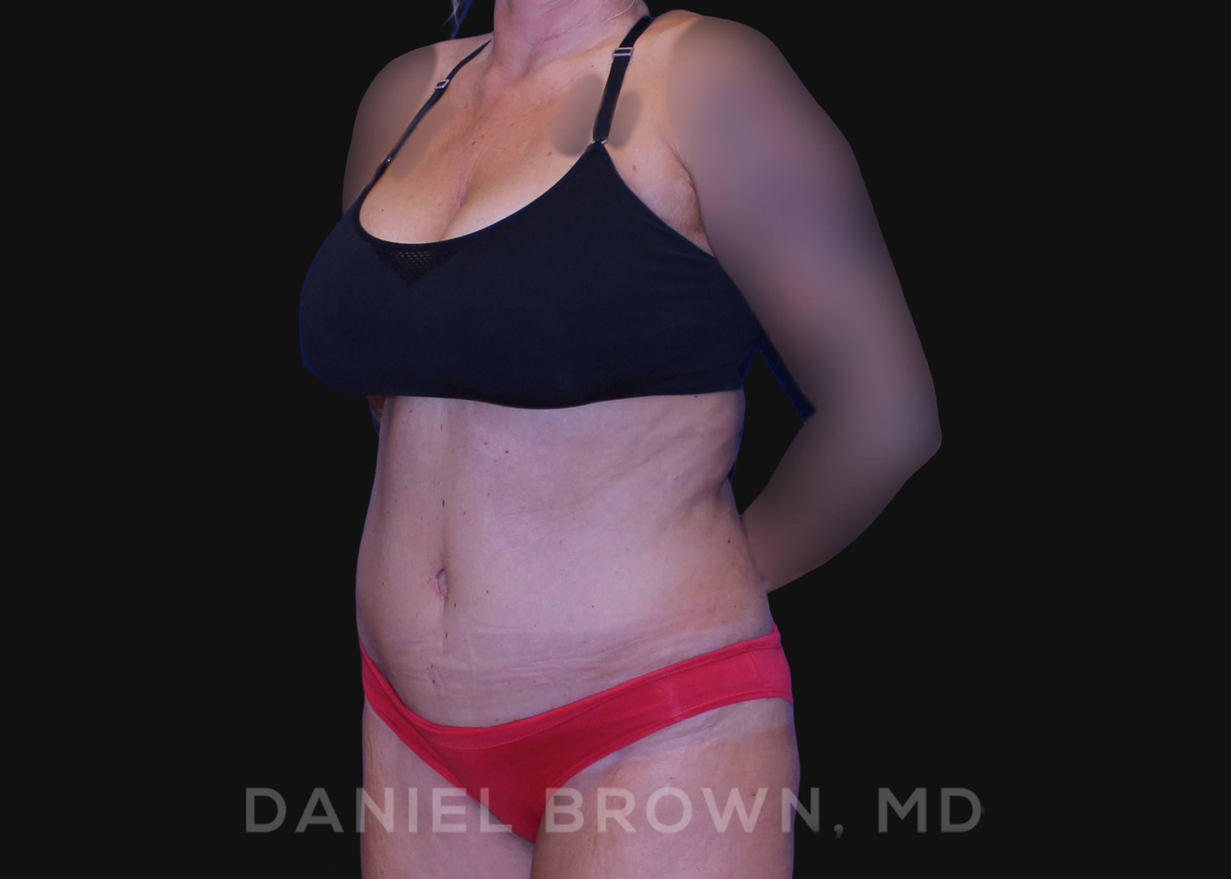 Tummy Tuck Patient Photo - Case 1101 - after view-1