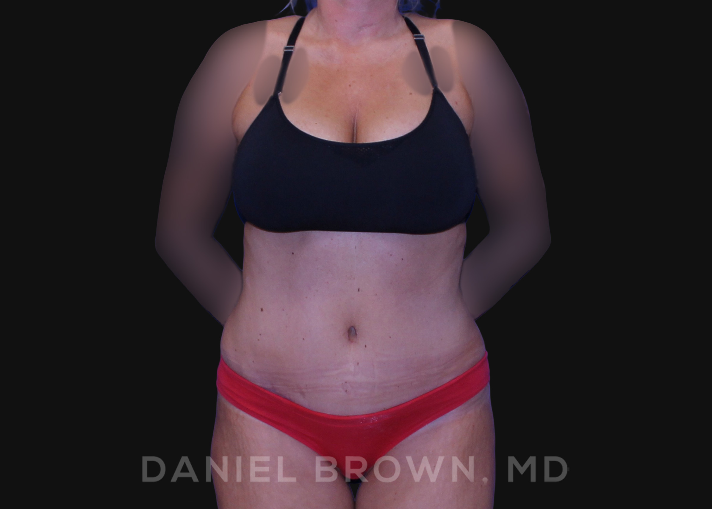 Tummy Tuck Patient Photo - Case 1101 - after view-0