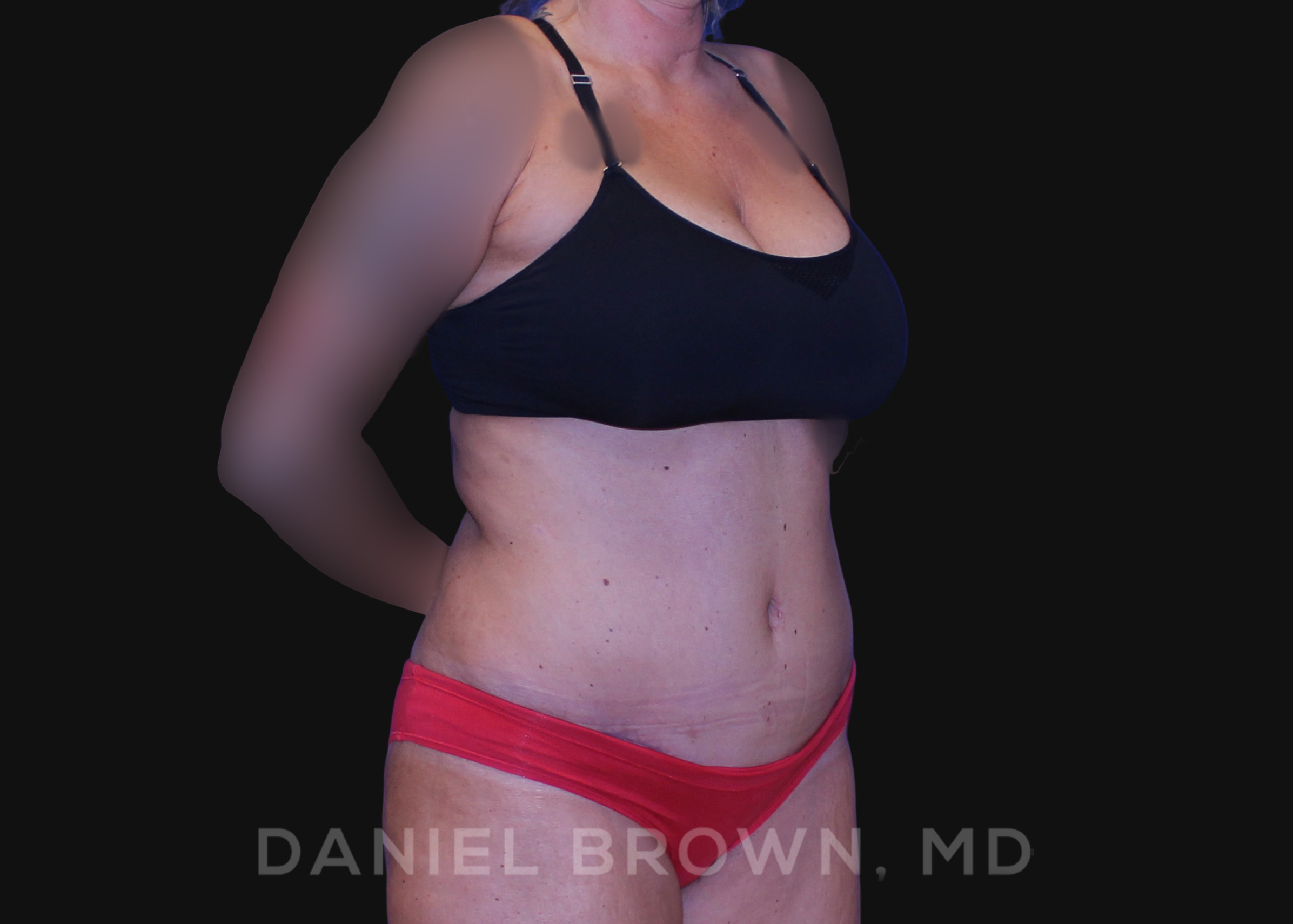 Tummy Tuck Patient Photo - Case 1101 - after view-2
