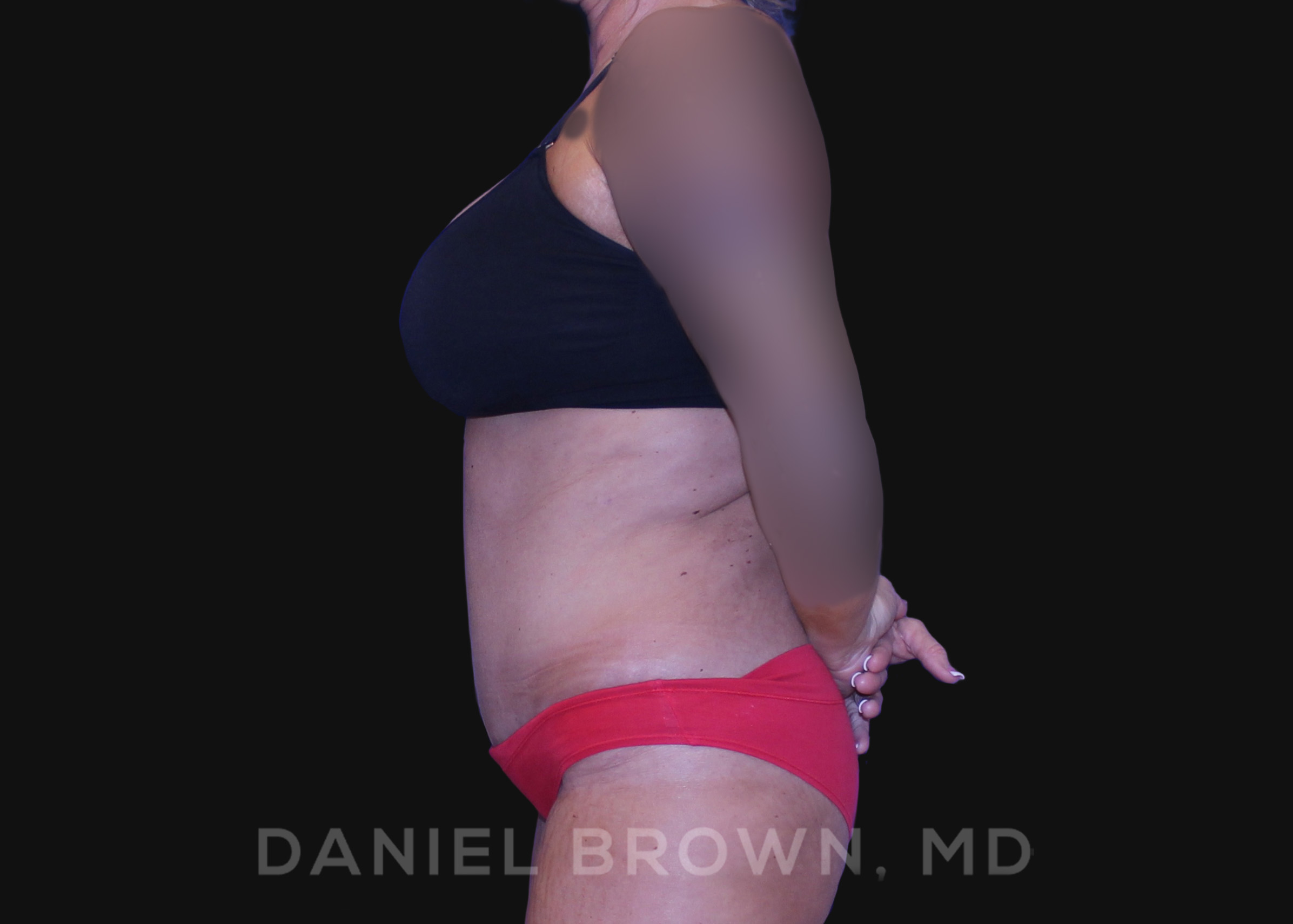 Tummy Tuck Patient Photo - Case 1101 - after view