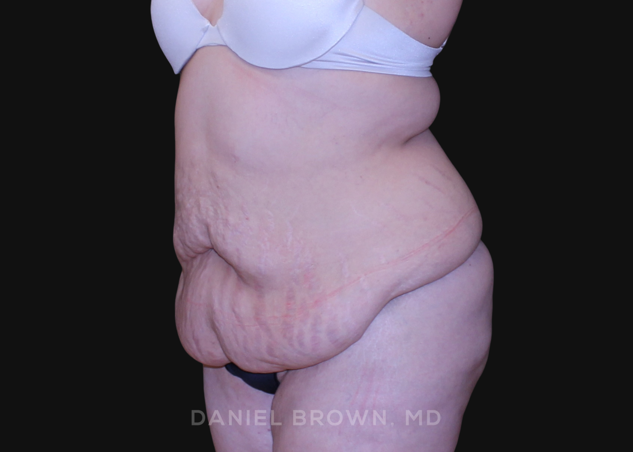 Tummy Tuck Patient Photo - Case 1112 - before view-1